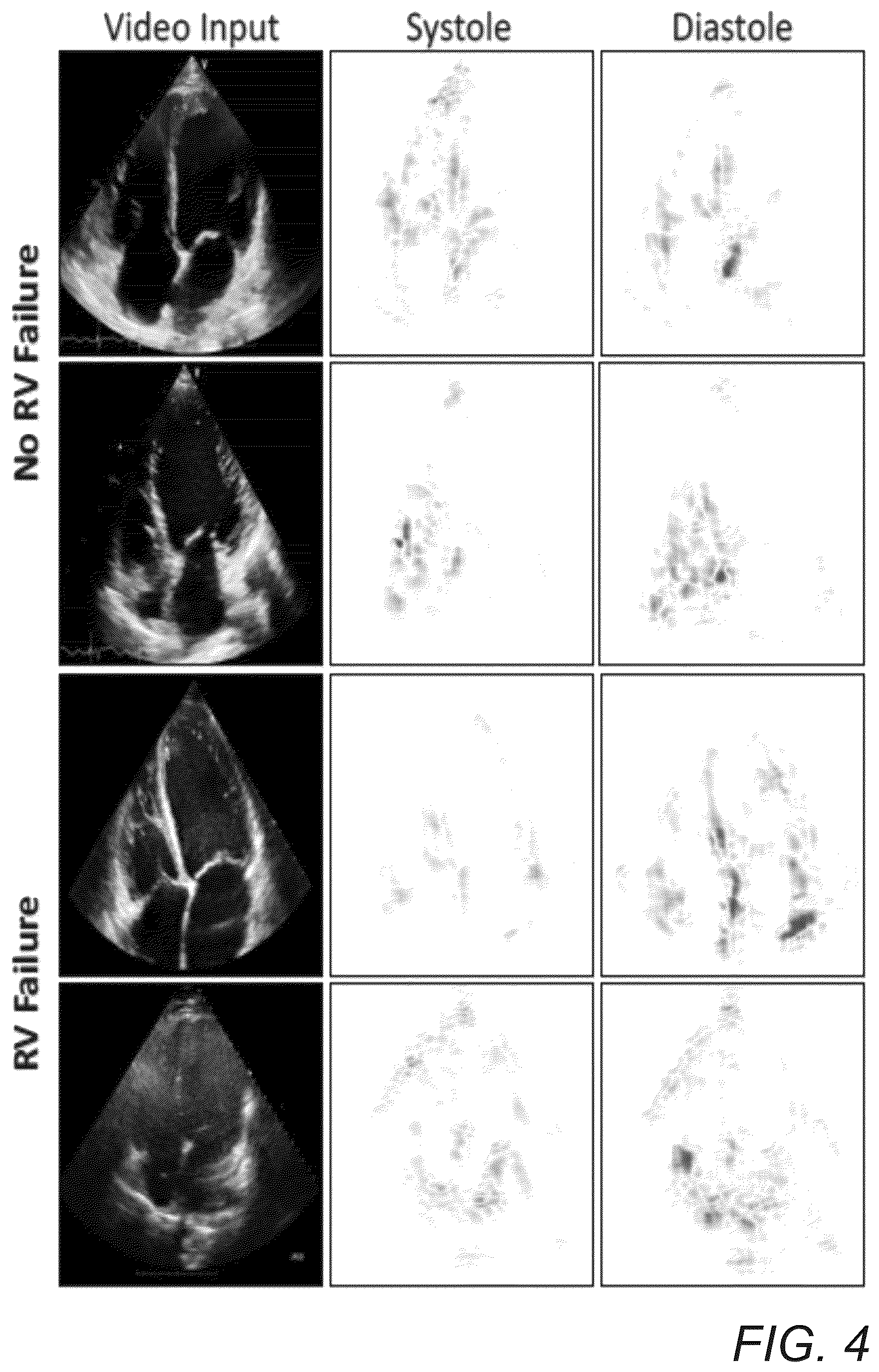 Patent US12307666 Figure 4 – Systems and methods for predicting post-operative right ventricular failure using echocardiograms