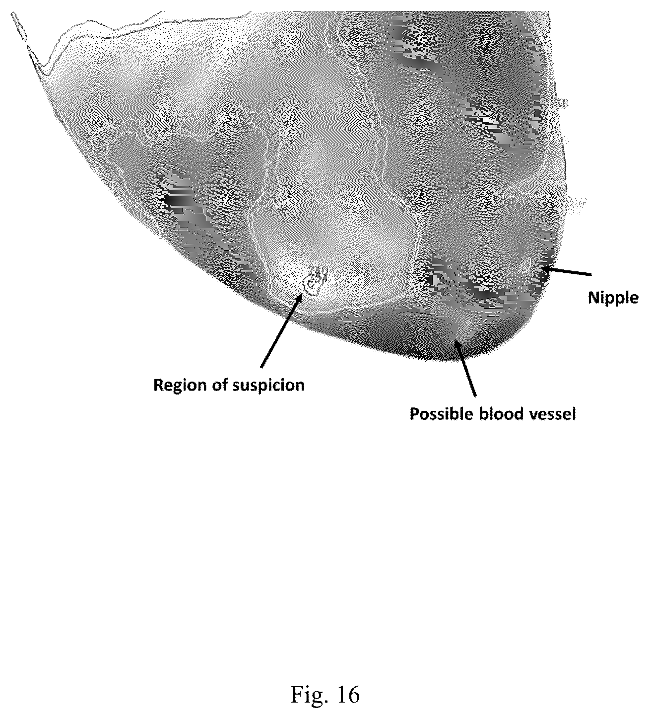 Patent US12307669 Figure 16 – Detection and characterization of cancerous tumors