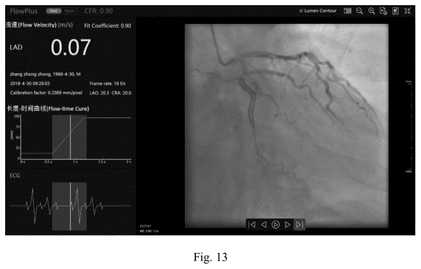 Patent US12307672 Figure 8 – Method and apparatus for calculating blood flow rate in coronary artery, and electronic device