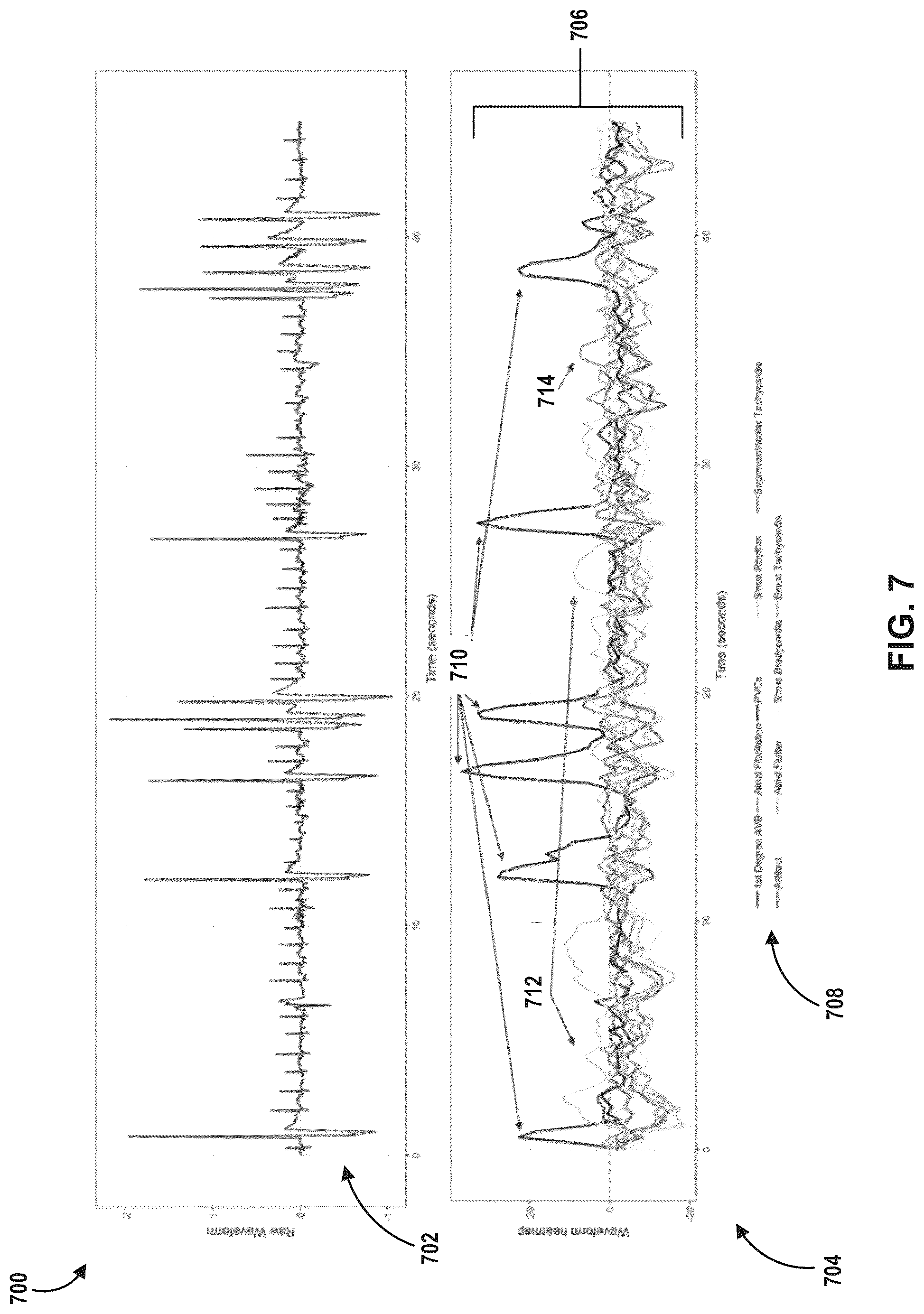 Patent US12308121 Figure 7 – Machine learning based depolarization identification and arrhythmia localization visualization