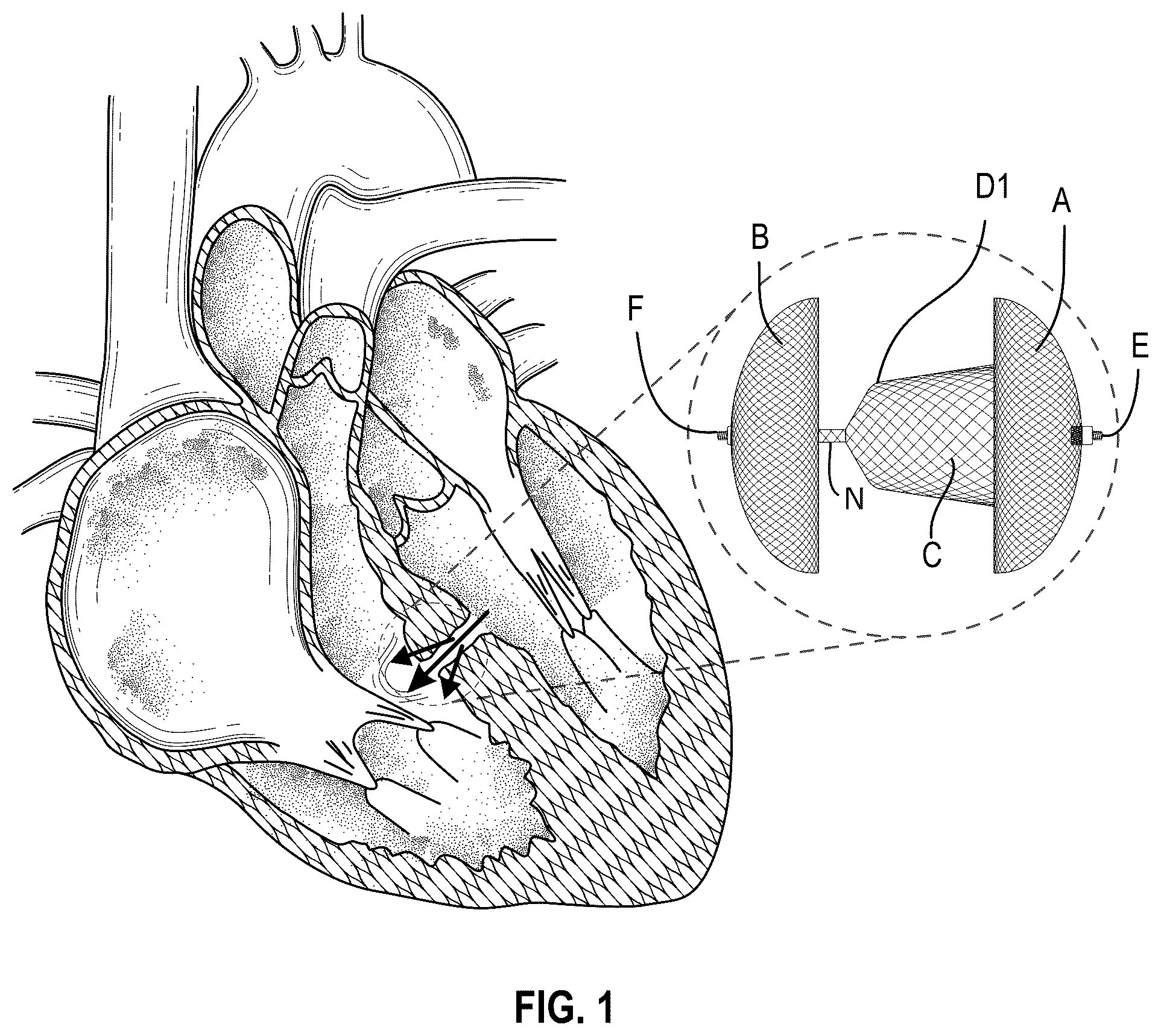 Patent US12310568 — Multi-functional occluder — Figure 1
