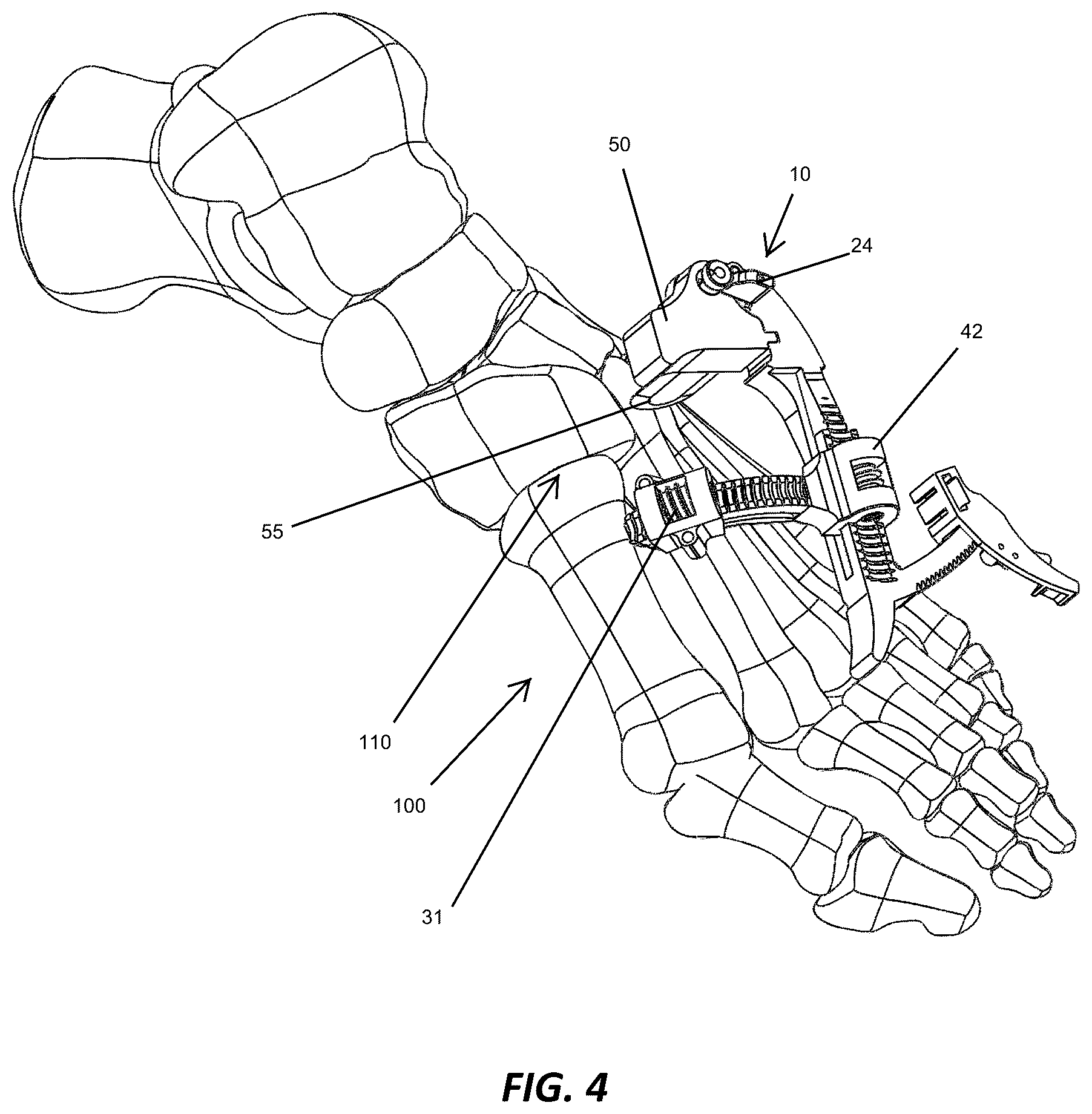 Patent US12310572 Figure 4 – Bone align and joint preparation device and method