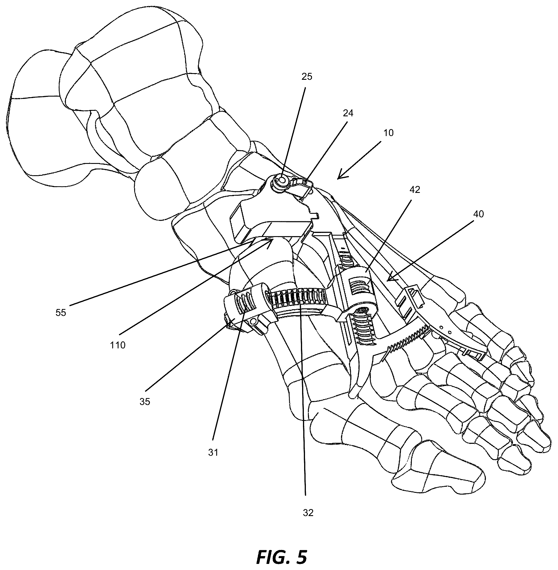 Patent US12310572 Figure 5 – Bone align and joint preparation device and method
