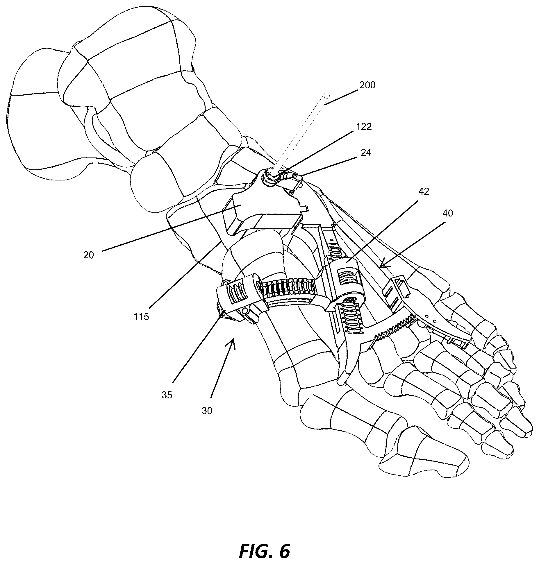 Patent US12310572 Figure 6 – Bone align and joint preparation device and method