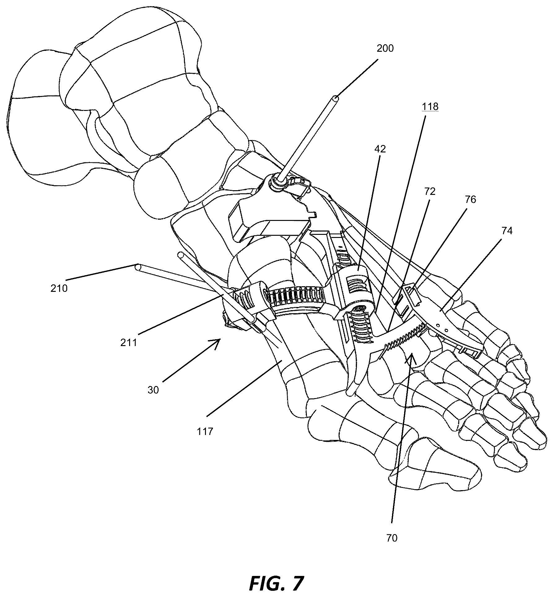 Patent US12310572 Figure 7 – Bone align and joint preparation device and method