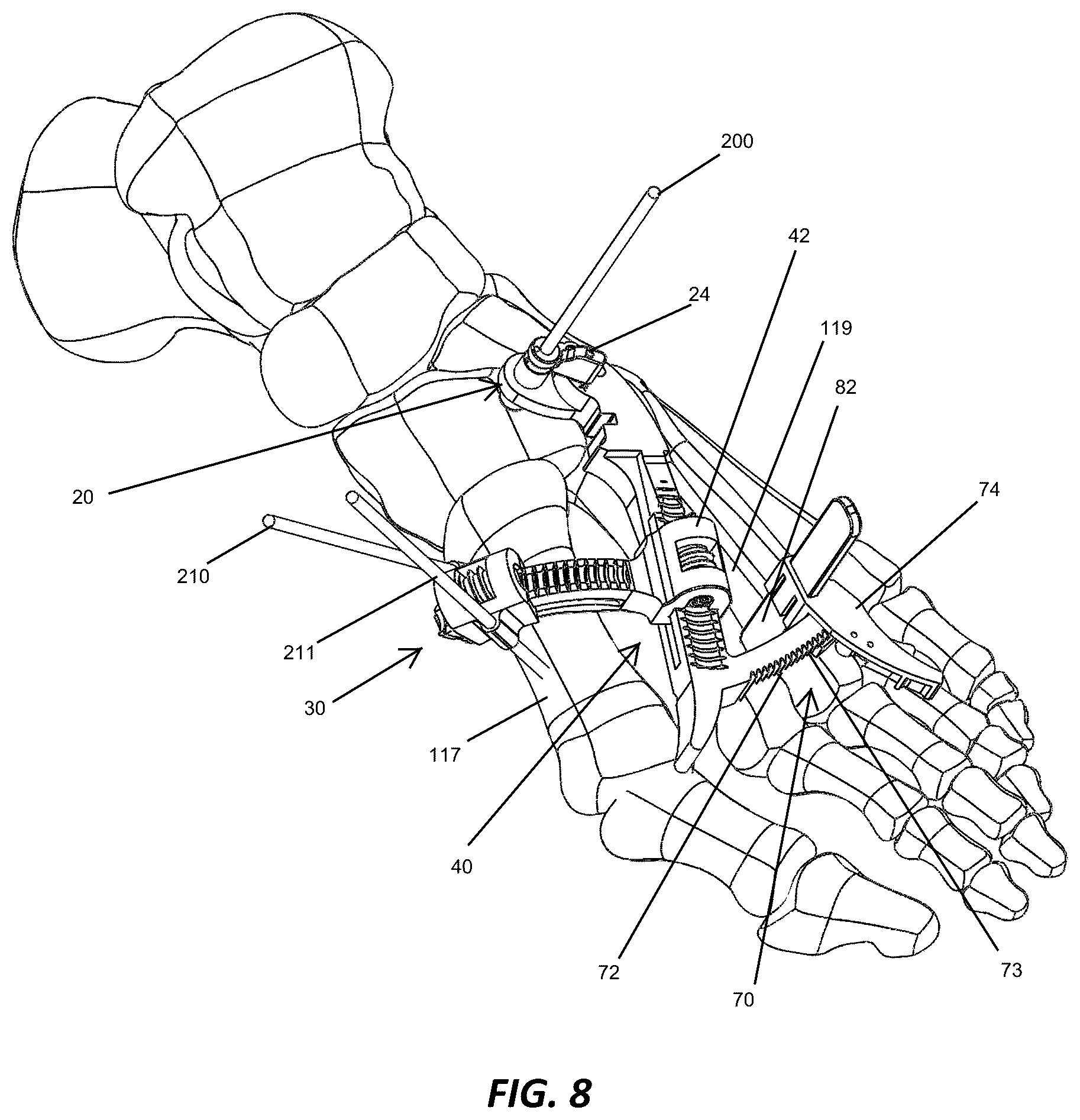 Patent US12310572 Figure 8 – Bone align and joint preparation device and method