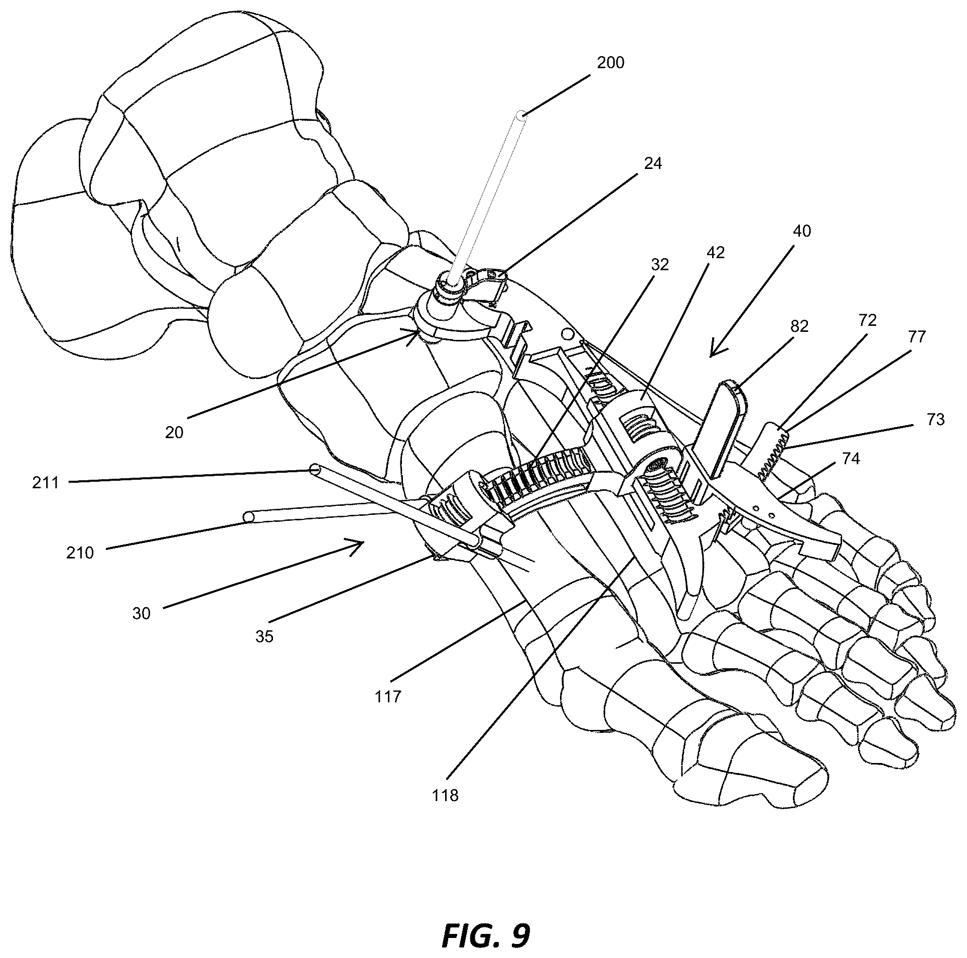 Patent US12310572 Figure 9 – Bone align and joint preparation device and method