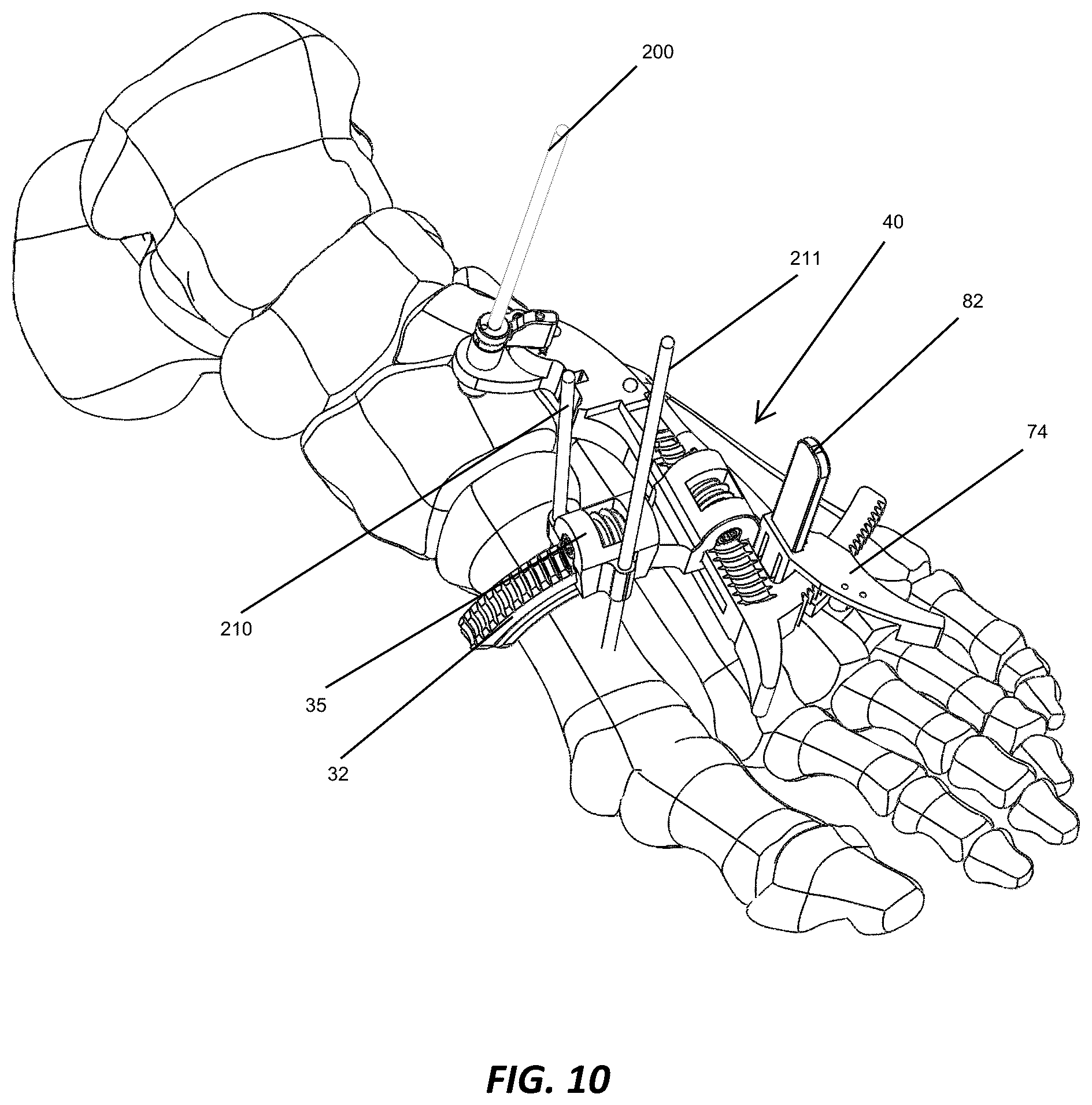 Patent US12310572 Figure 10 – Bone align and joint preparation device and method