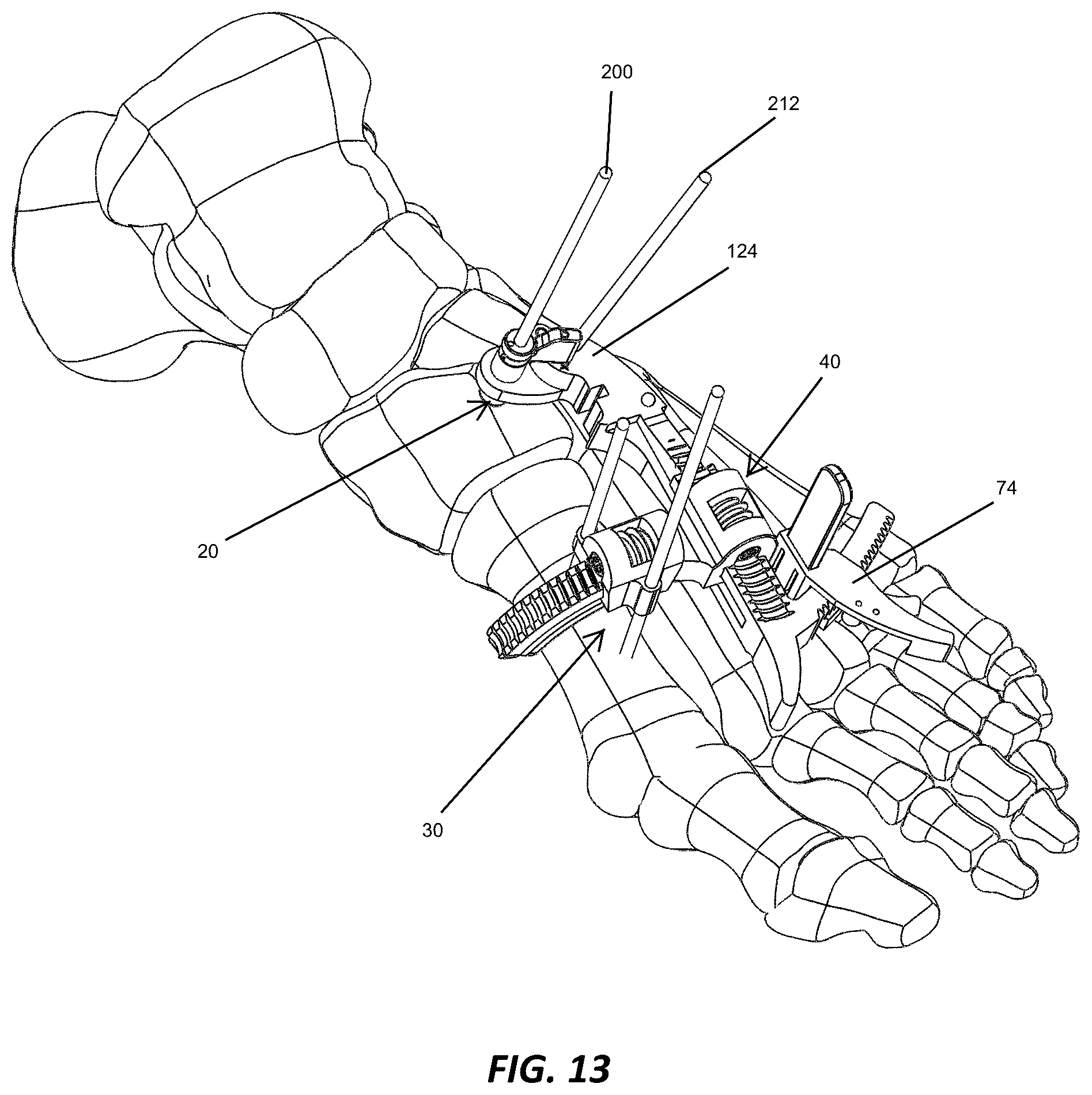 Patent US12310572 Figure 12 – Bone align and joint preparation device and method