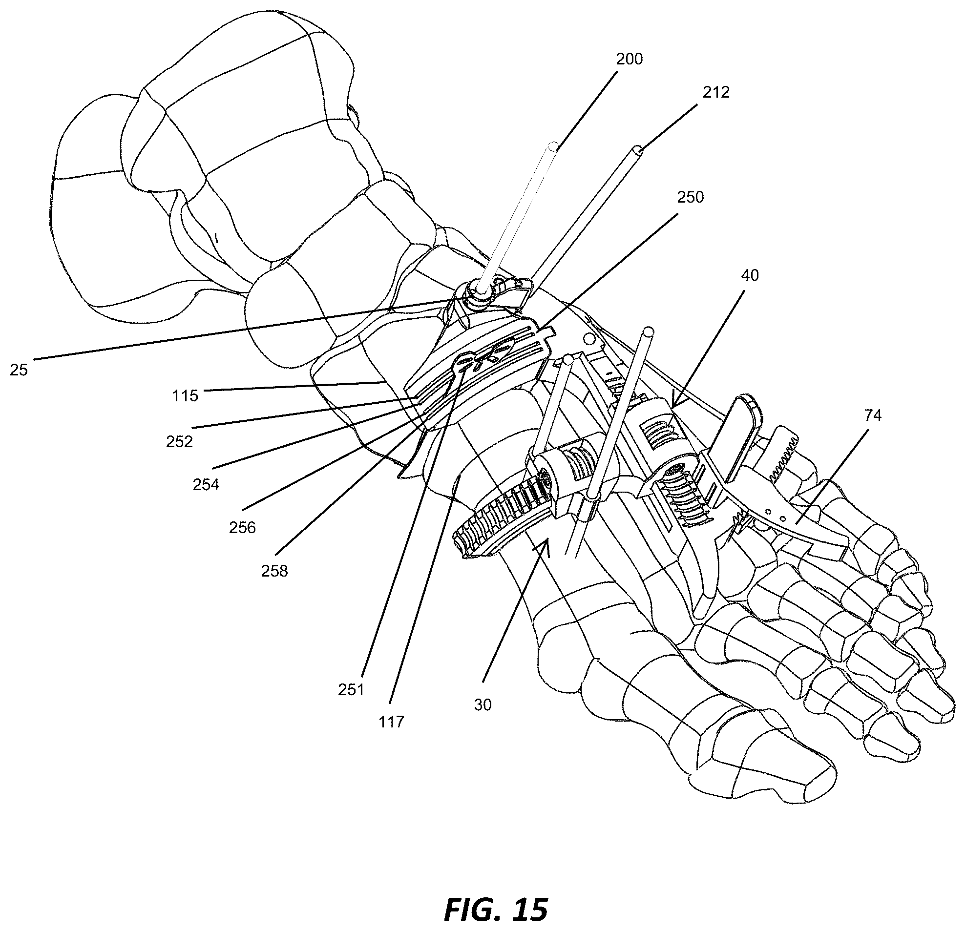 Patent US12310572 Figure 14 – Bone align and joint preparation device and method
