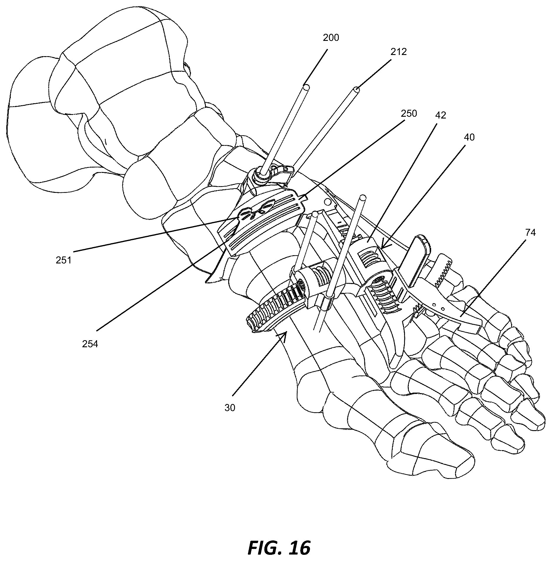 Patent US12310572 Figure 15 – Bone align and joint preparation device and method