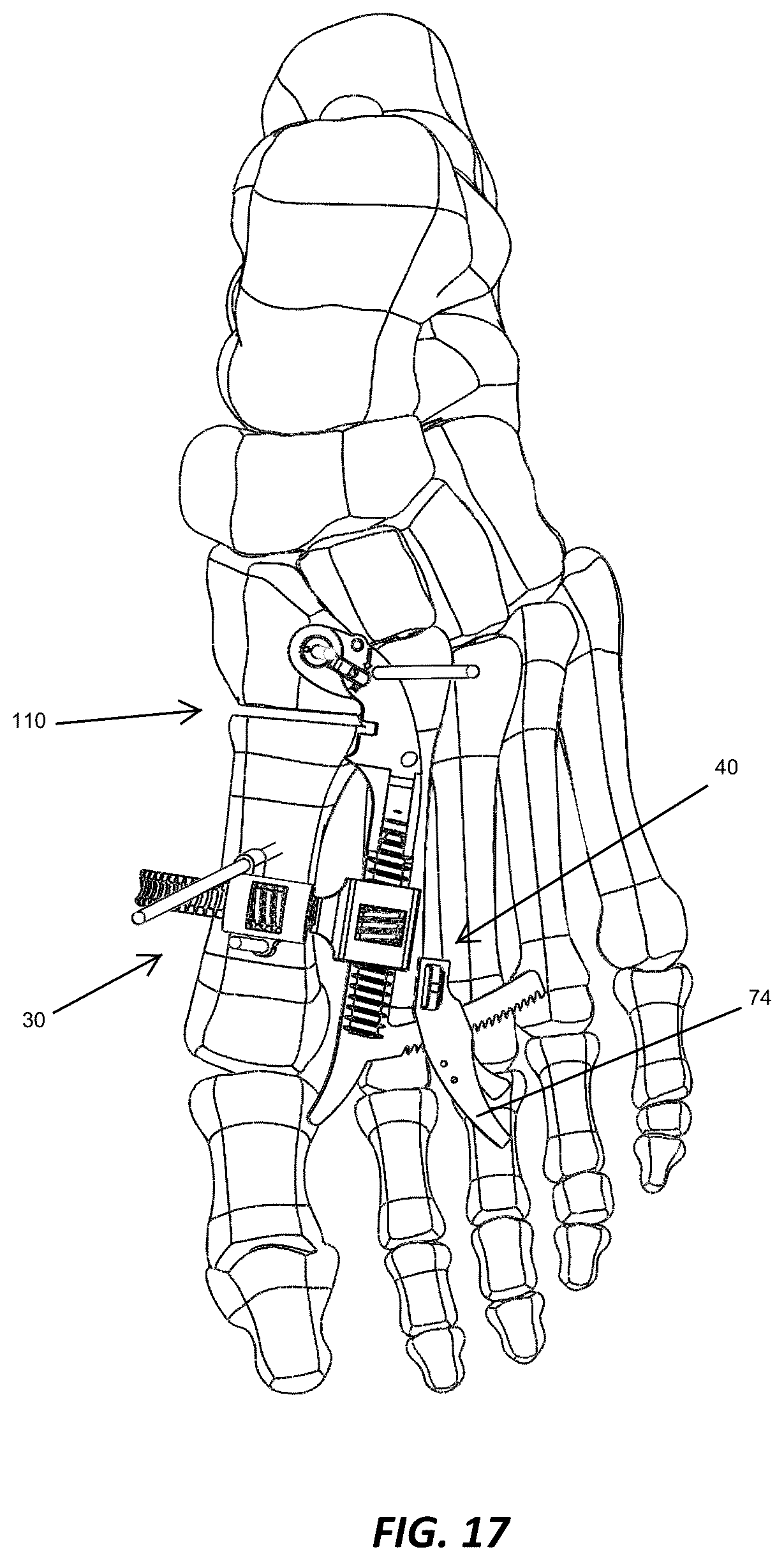 Patent US12310572 Figure 16 – Bone align and joint preparation device and method