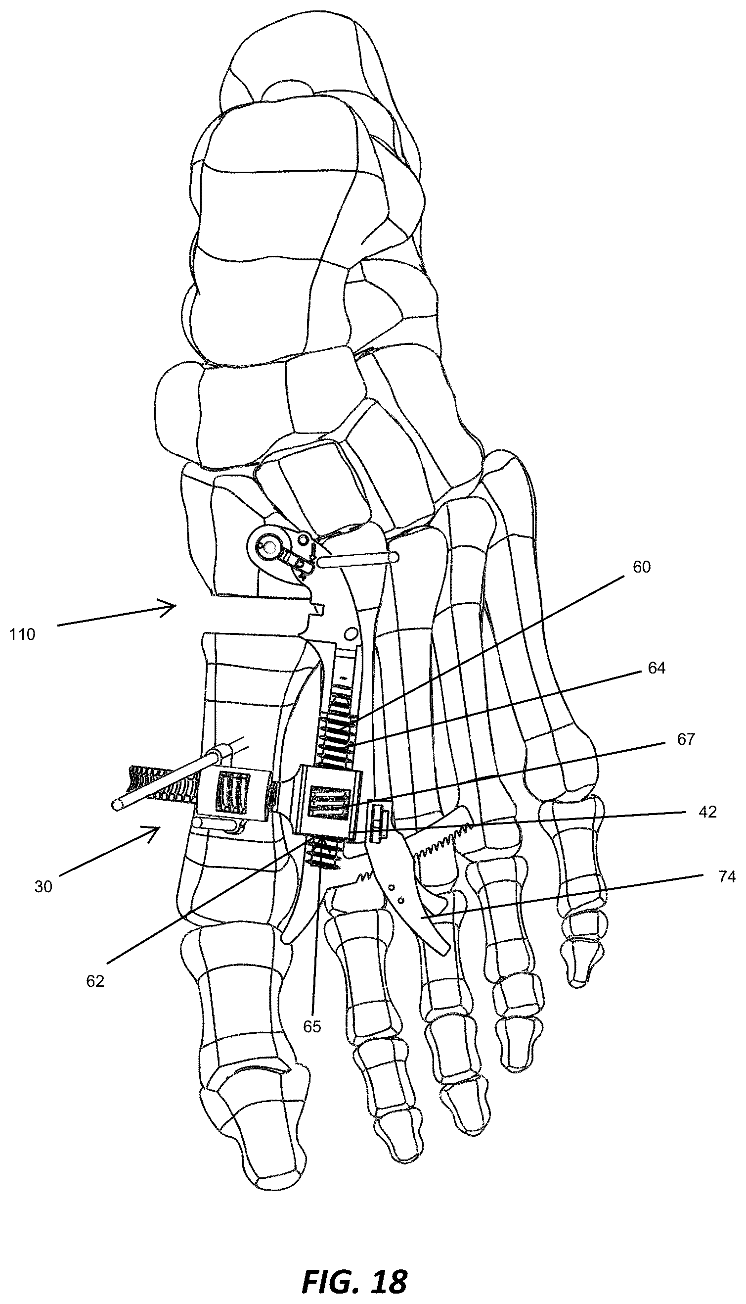 Patent US12310572 Figure 17 – Bone align and joint preparation device and method