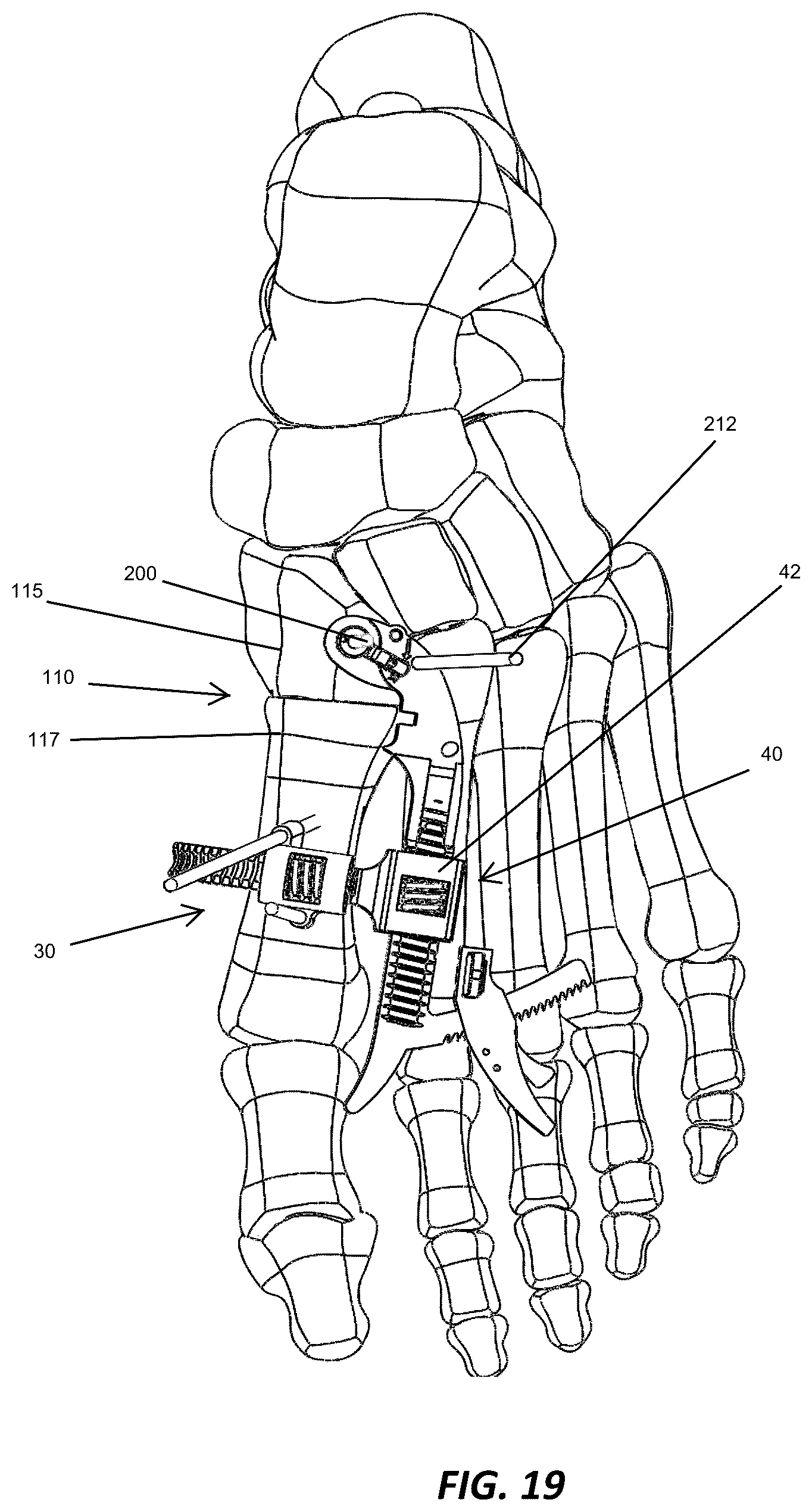 Patent US12310572 Figure 18 – Bone align and joint preparation device and method