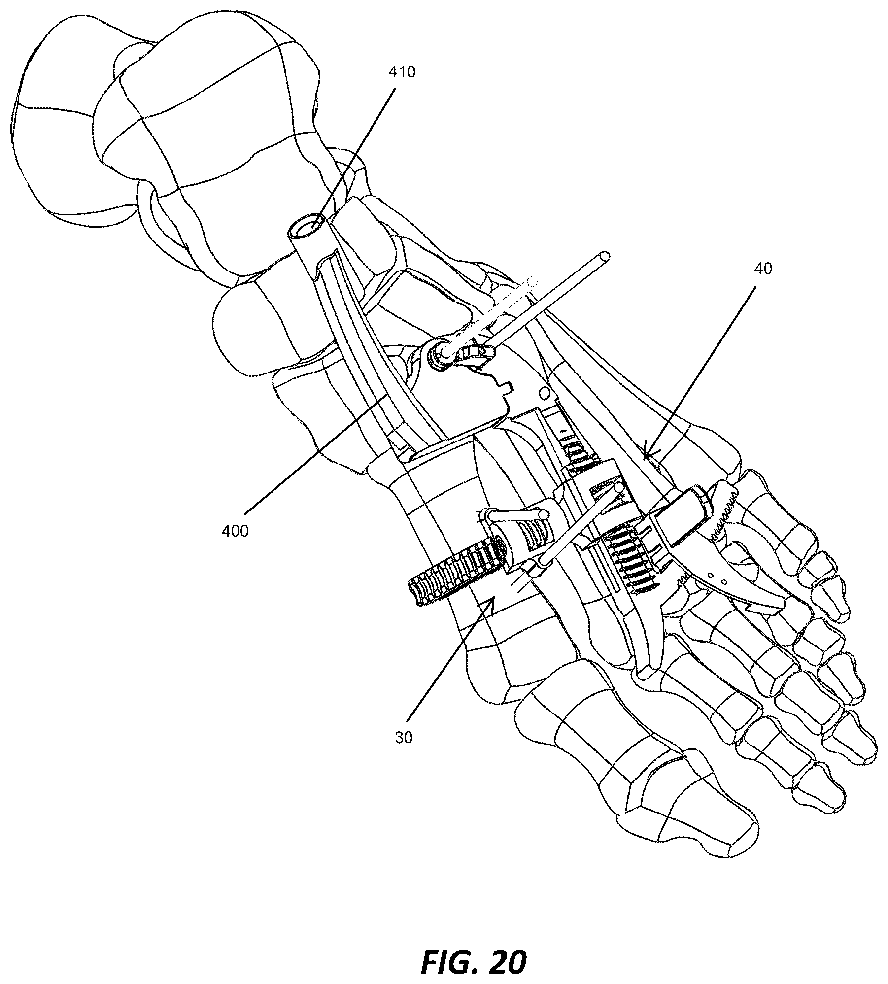 Patent US12310572 Figure 19 – Bone align and joint preparation device and method