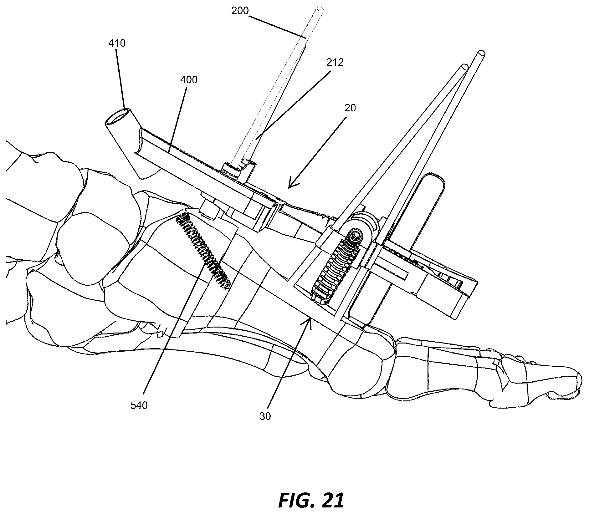 Patent US12310572 Figure 20 – Bone align and joint preparation device and method