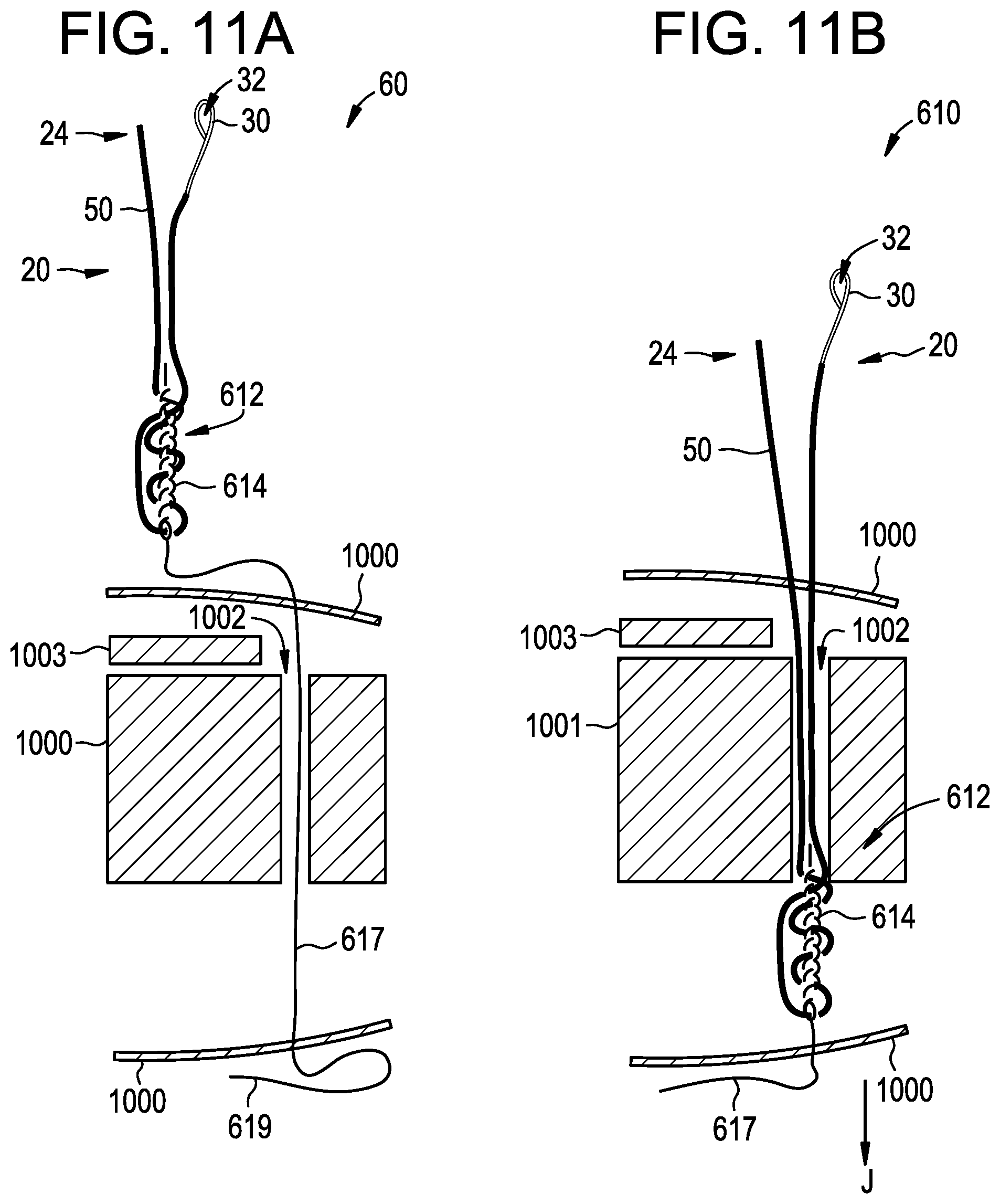Patent US12310573 Figure 11 – Systems, devices, and methods for securing tissue using snare assemblies and soft anchors