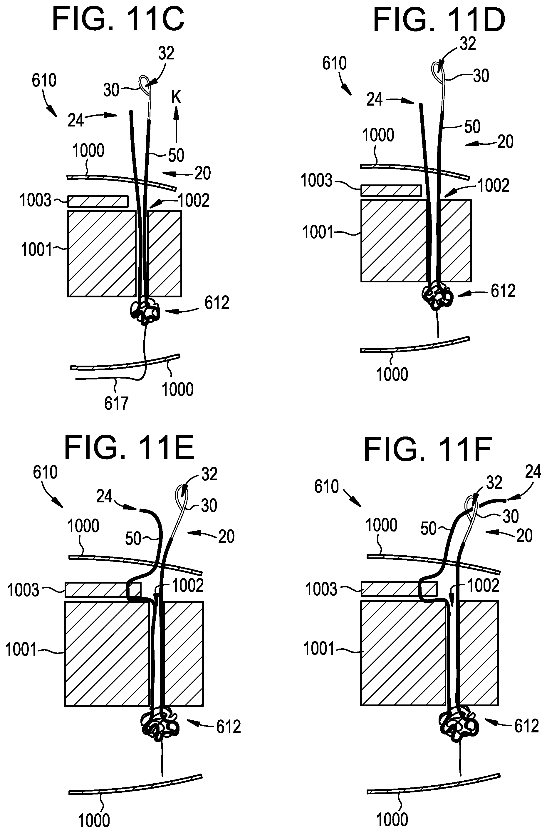 Patent US12310573 Figure 12 – Systems, devices, and methods for securing tissue using snare assemblies and soft anchors