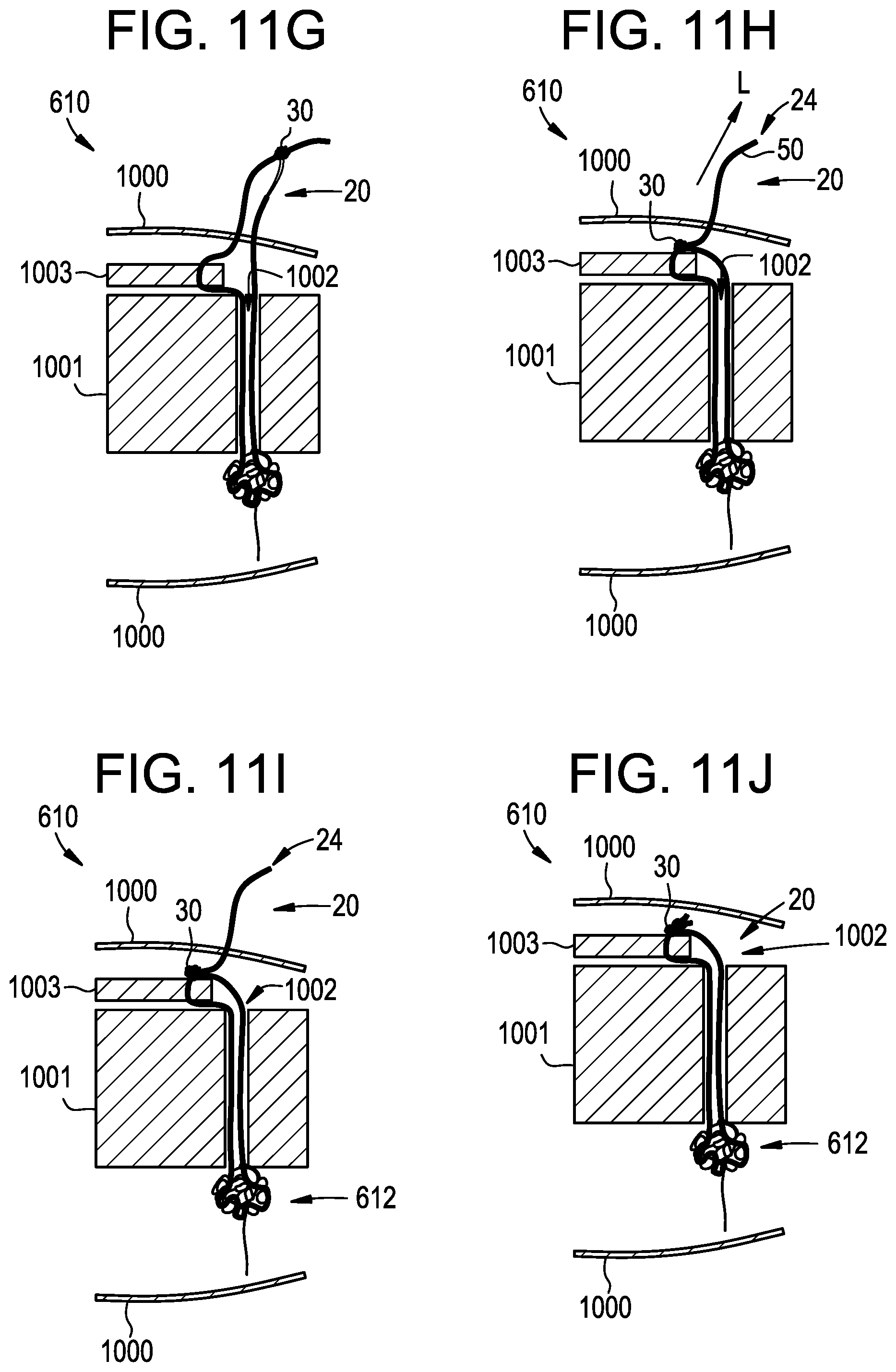 Patent US12310573 Figure 13 – Systems, devices, and methods for securing tissue using snare assemblies and soft anchors