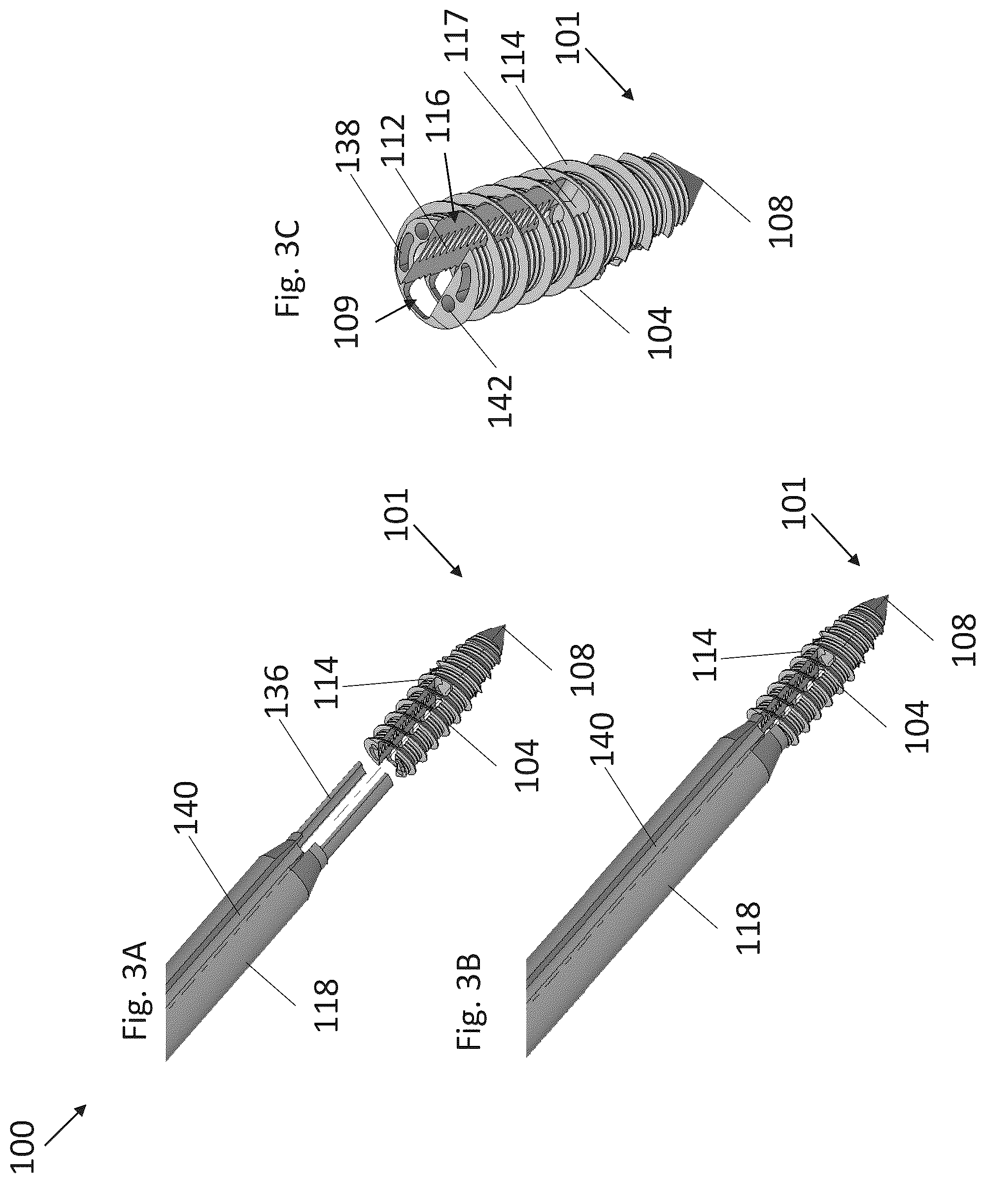 Patent US12310574 Figure 5 – Knotless suture anchor with re-tension features