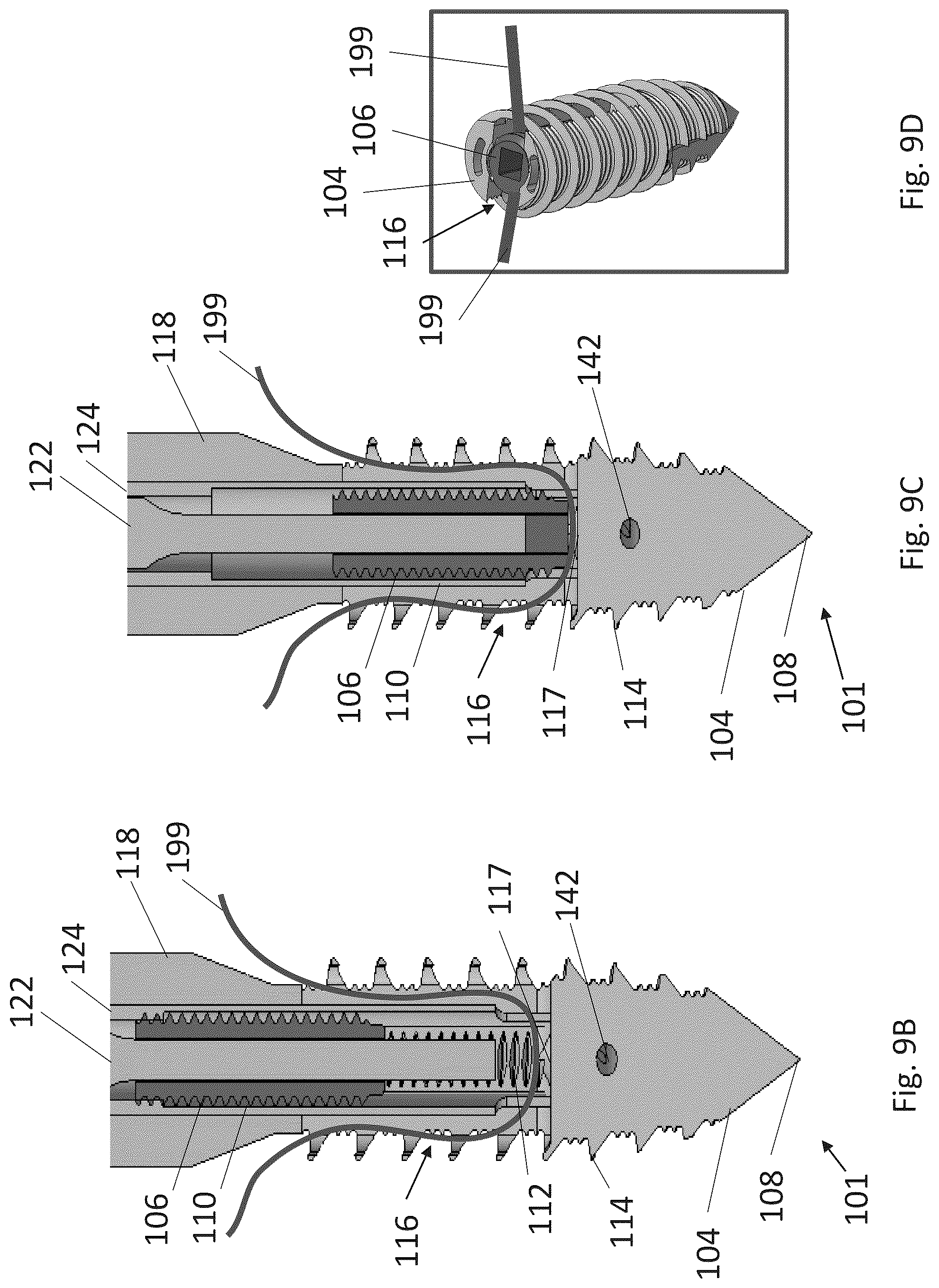 Patent US12310574 Figure 12 – Knotless suture anchor with re-tension features