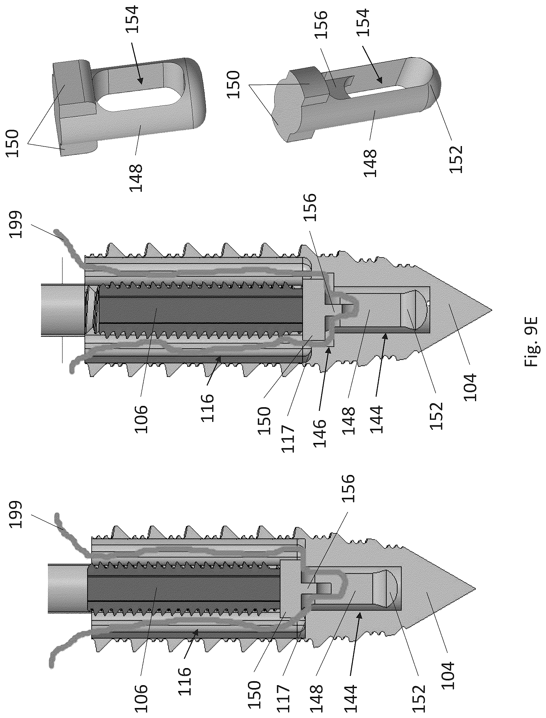 Patent US12310574 Figure 13 – Knotless suture anchor with re-tension features