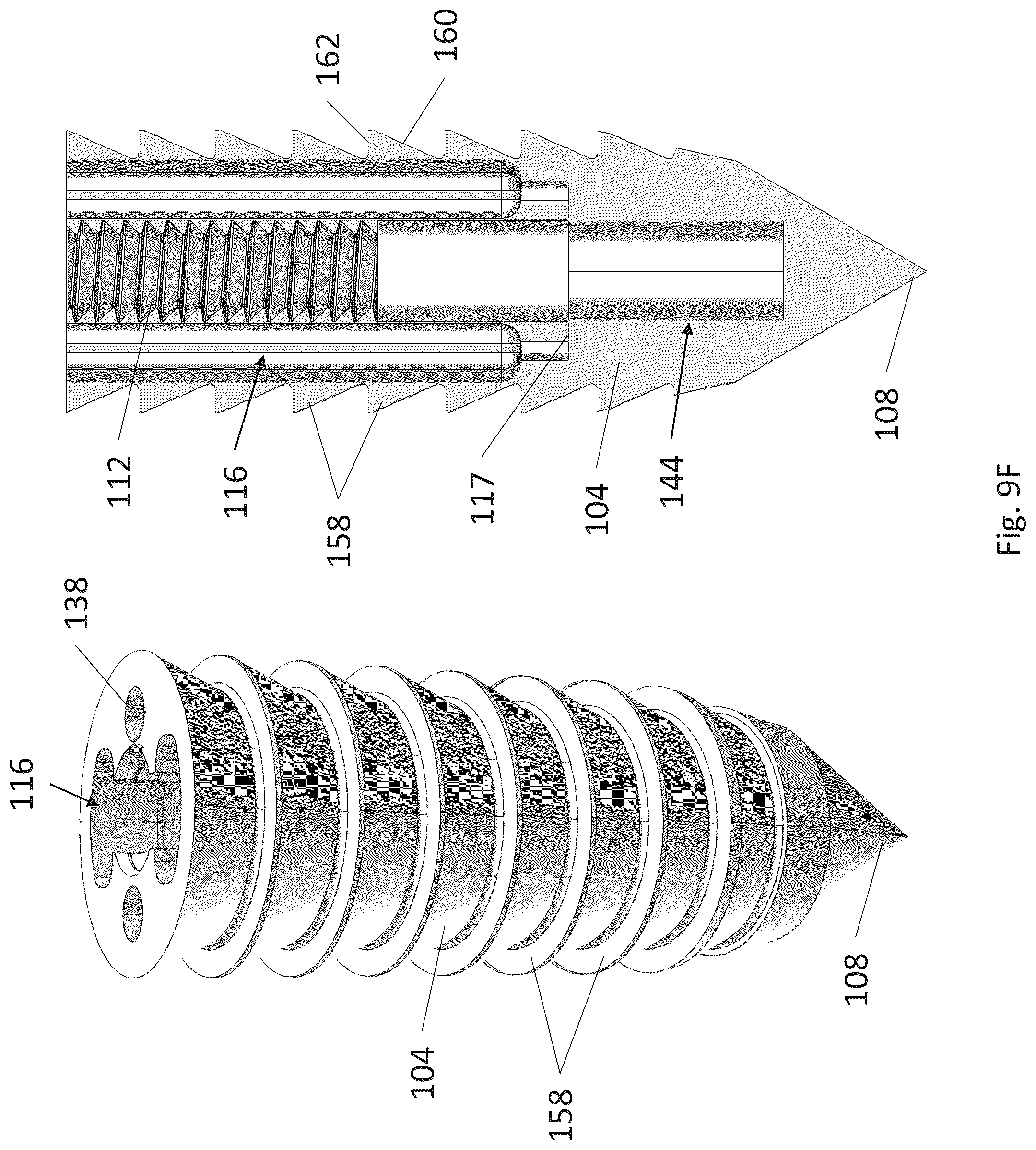 Patent US12310574 Figure 14 – Knotless suture anchor with re-tension features