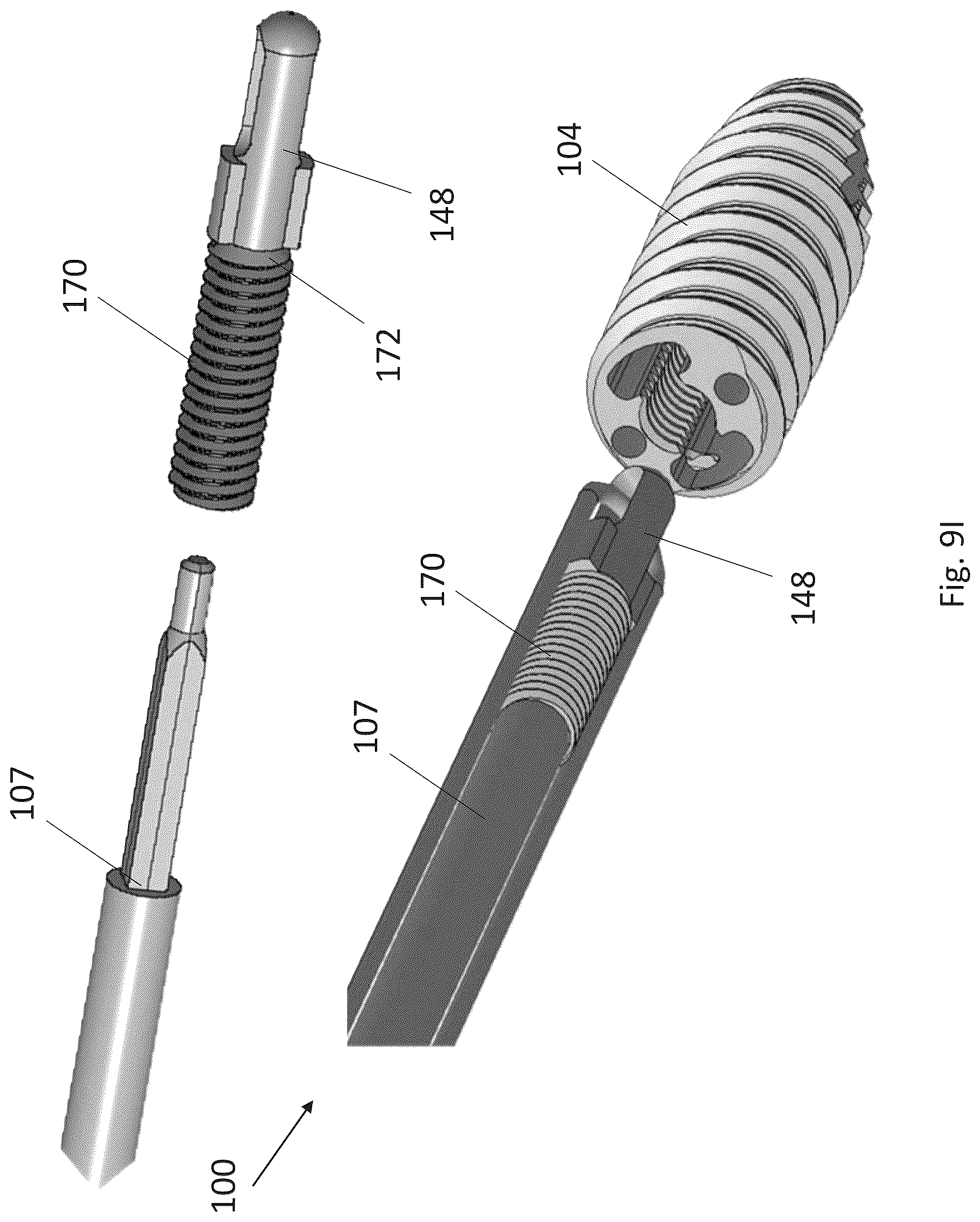 Patent US12310574 Figure 17 – Knotless suture anchor with re-tension features