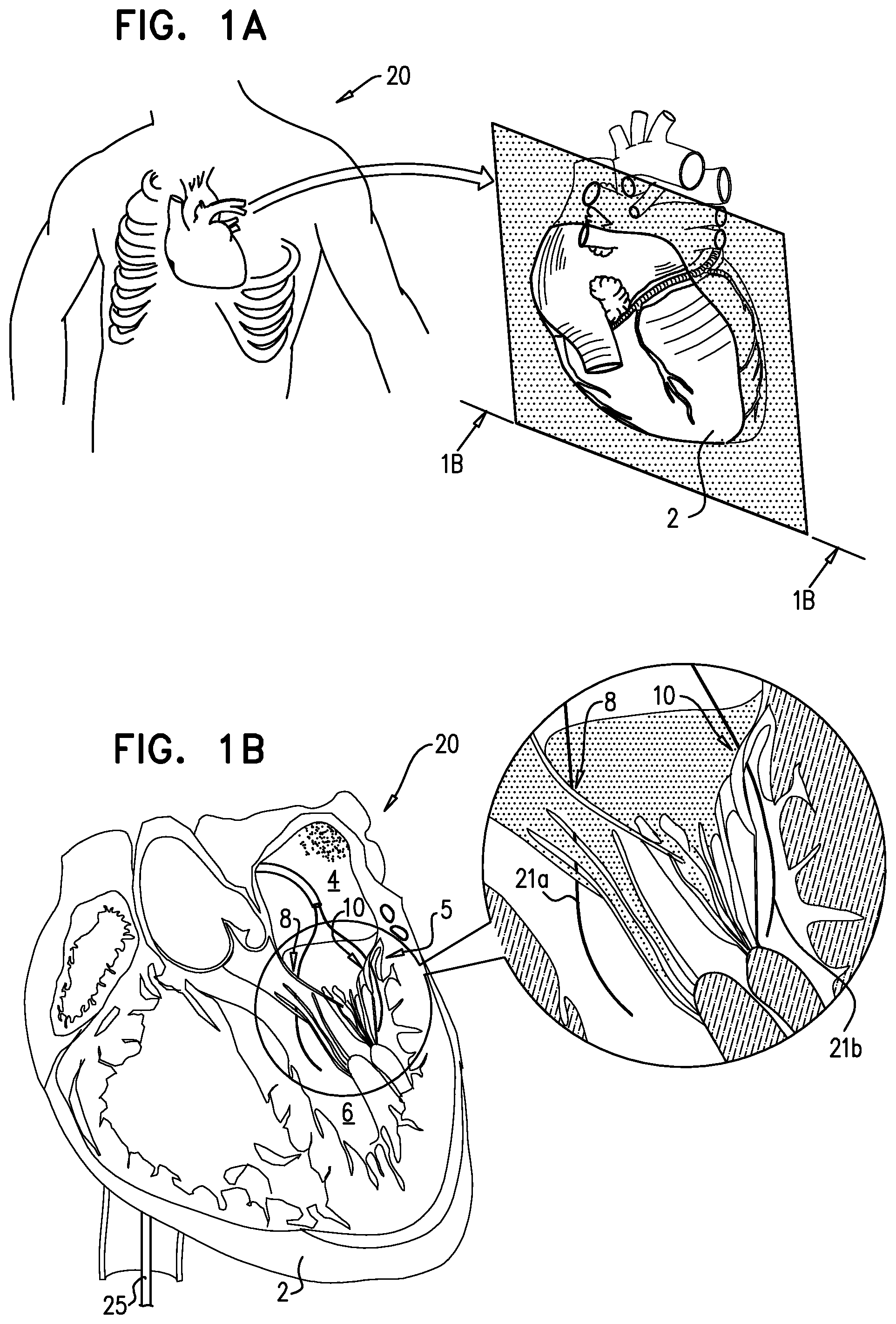 Patent US12310575 Figure 1 – Helical anchor implantation