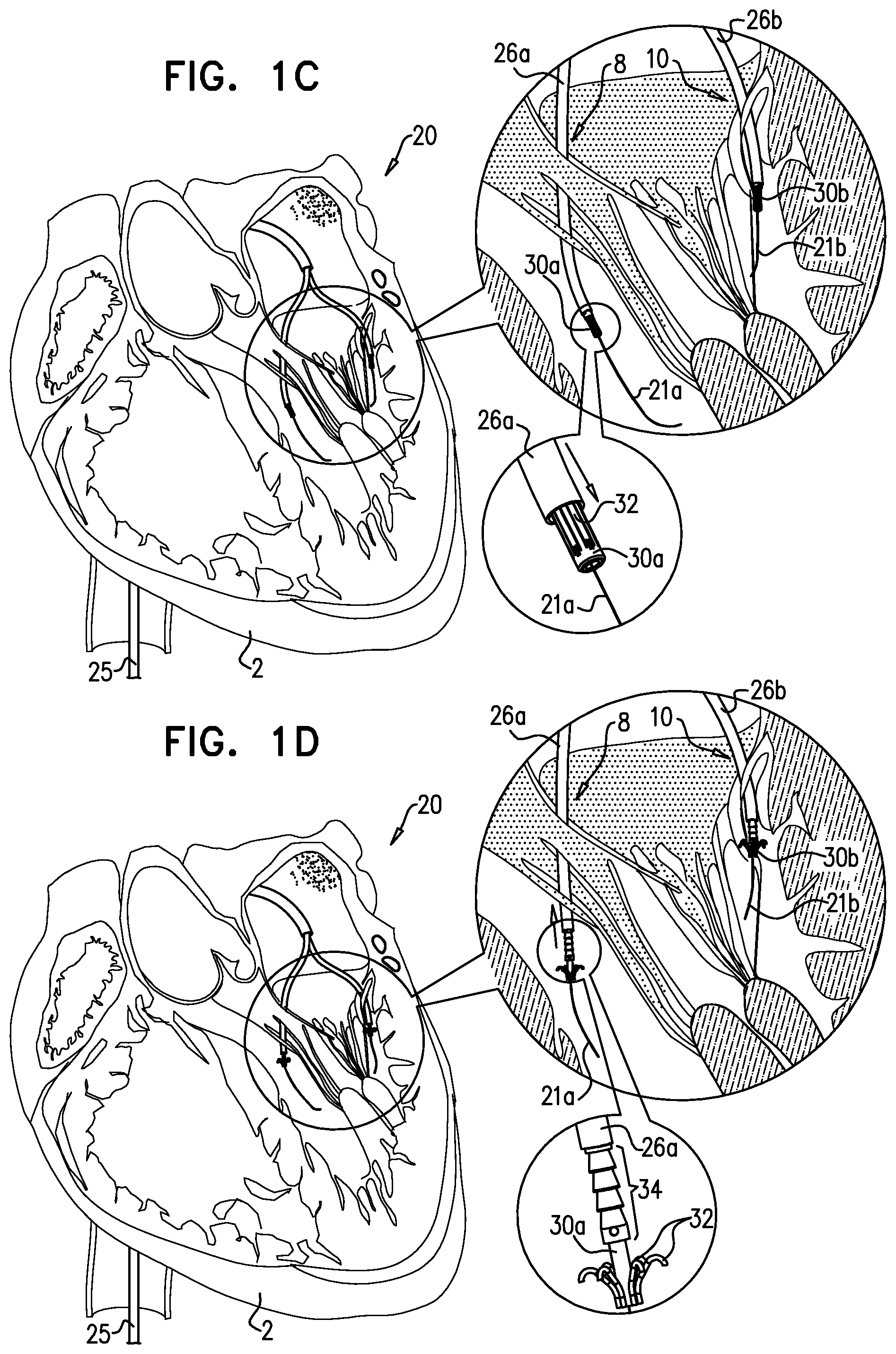Patent US12310575 Figure 2 – Helical anchor implantation