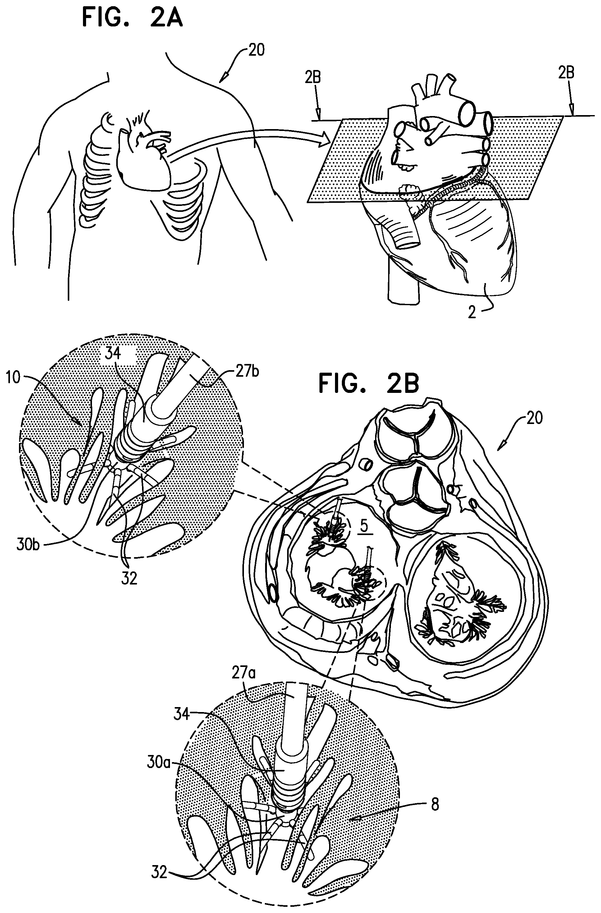 Patent US12310575 Figure 3 – Helical anchor implantation