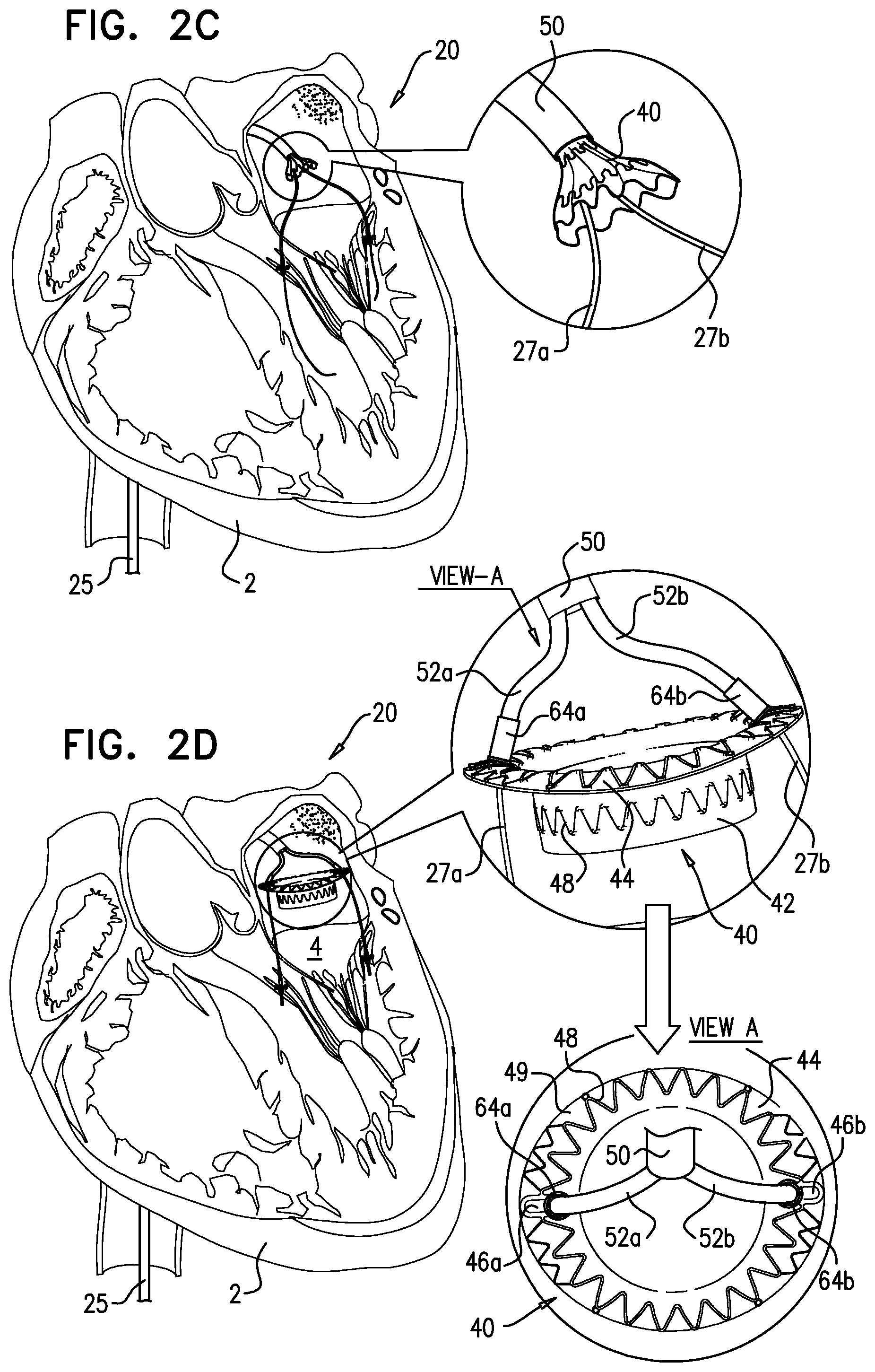 Patent US12310575 Figure 4 – Helical anchor implantation