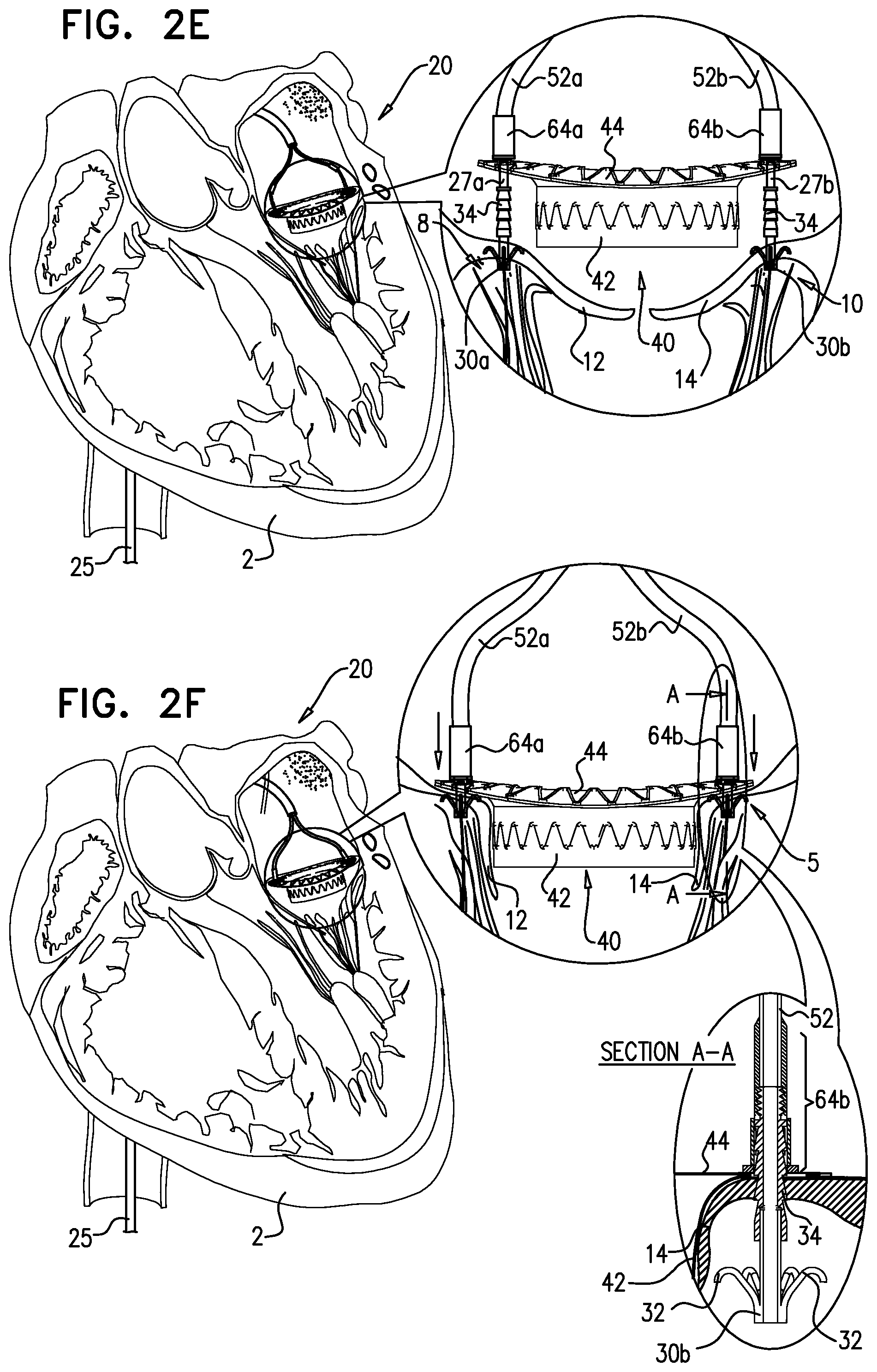 Patent US12310575 Figure 5 – Helical anchor implantation