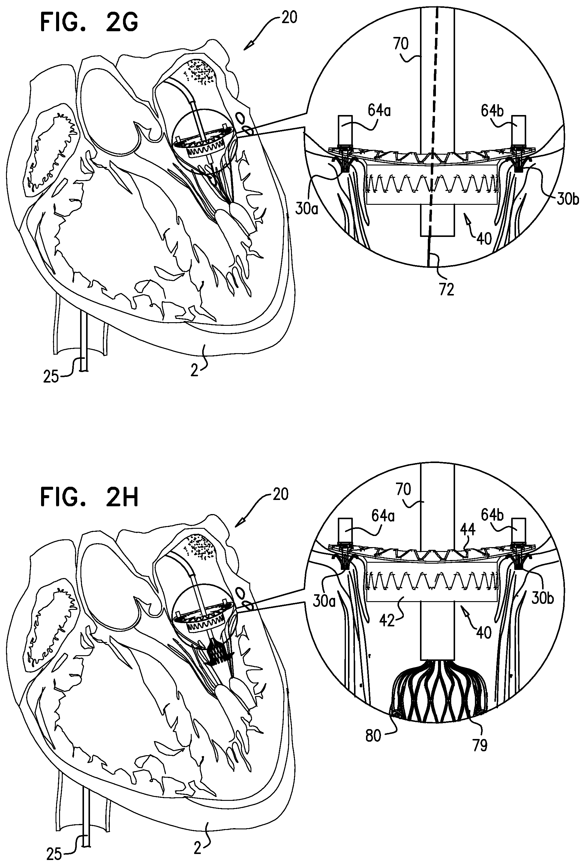 Patent US12310575 Figure 6 – Helical anchor implantation