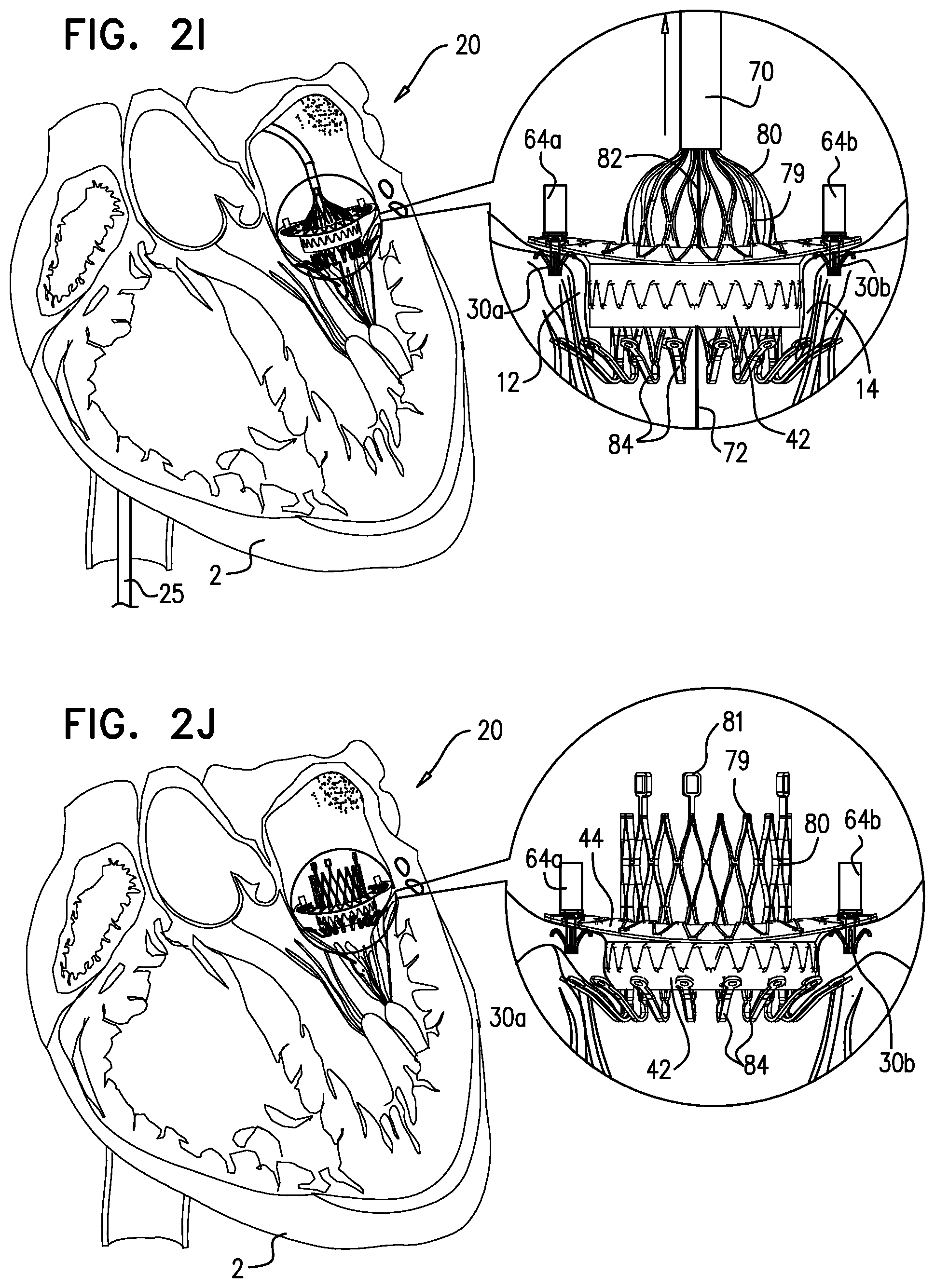 Patent US12310575 Figure 7 – Helical anchor implantation