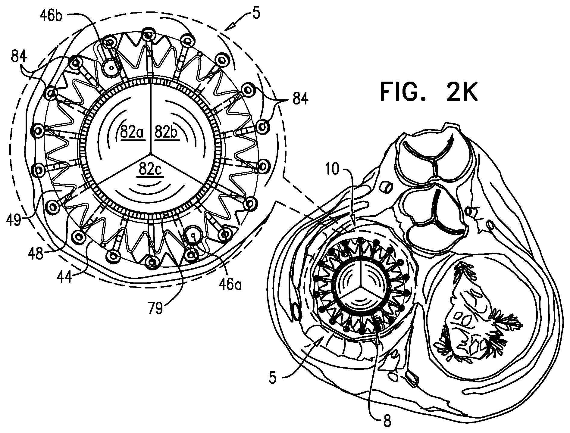 Patent US12310575 Figure 8 – Helical anchor implantation