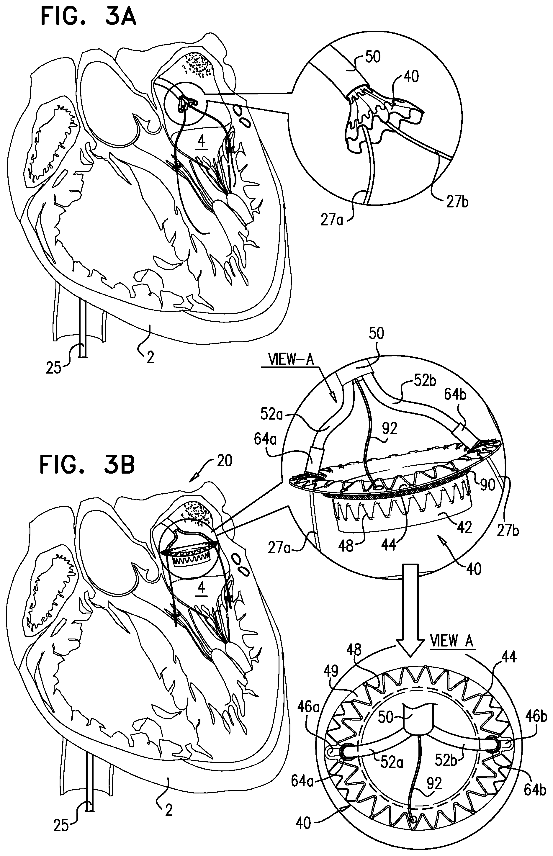 Patent US12310575 Figure 9 – Helical anchor implantation