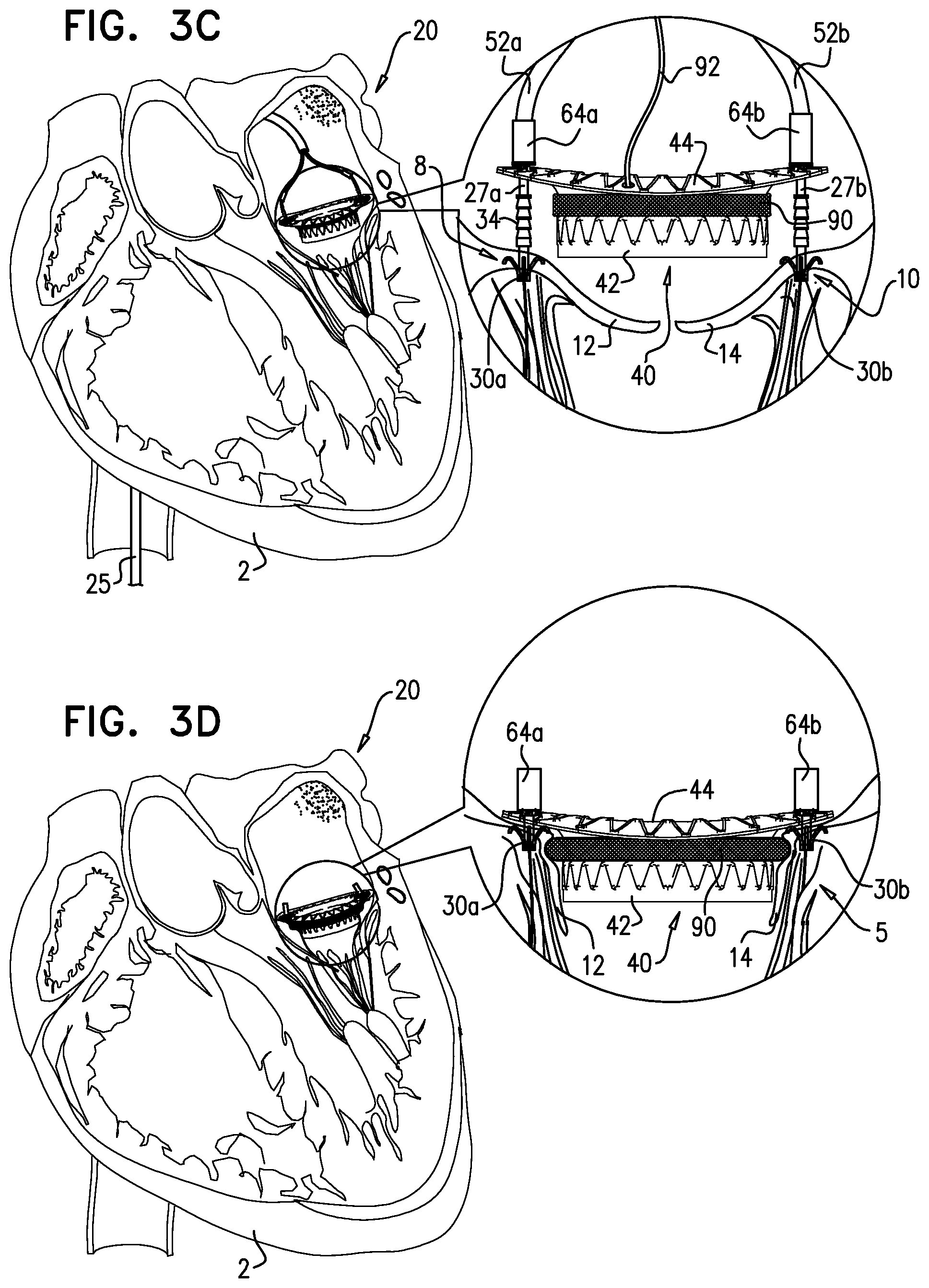 Patent US12310575 Figure 10 – Helical anchor implantation