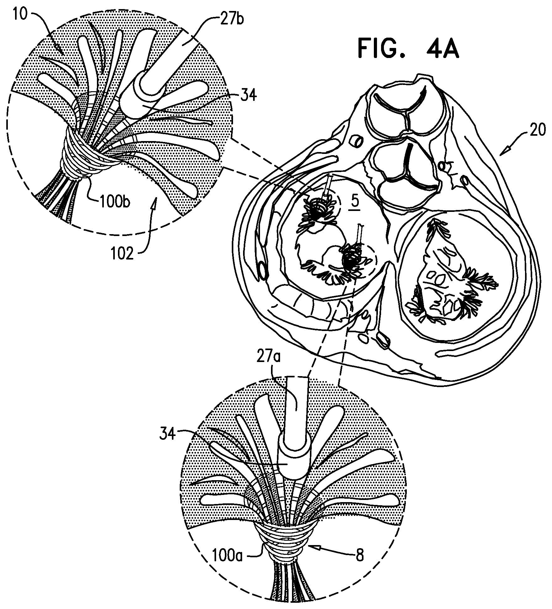 Patent US12310575 Figure 11 – Helical anchor implantation
