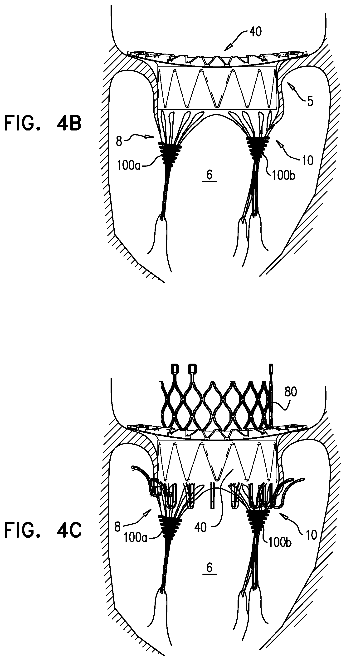 Patent US12310575 Figure 12 – Helical anchor implantation