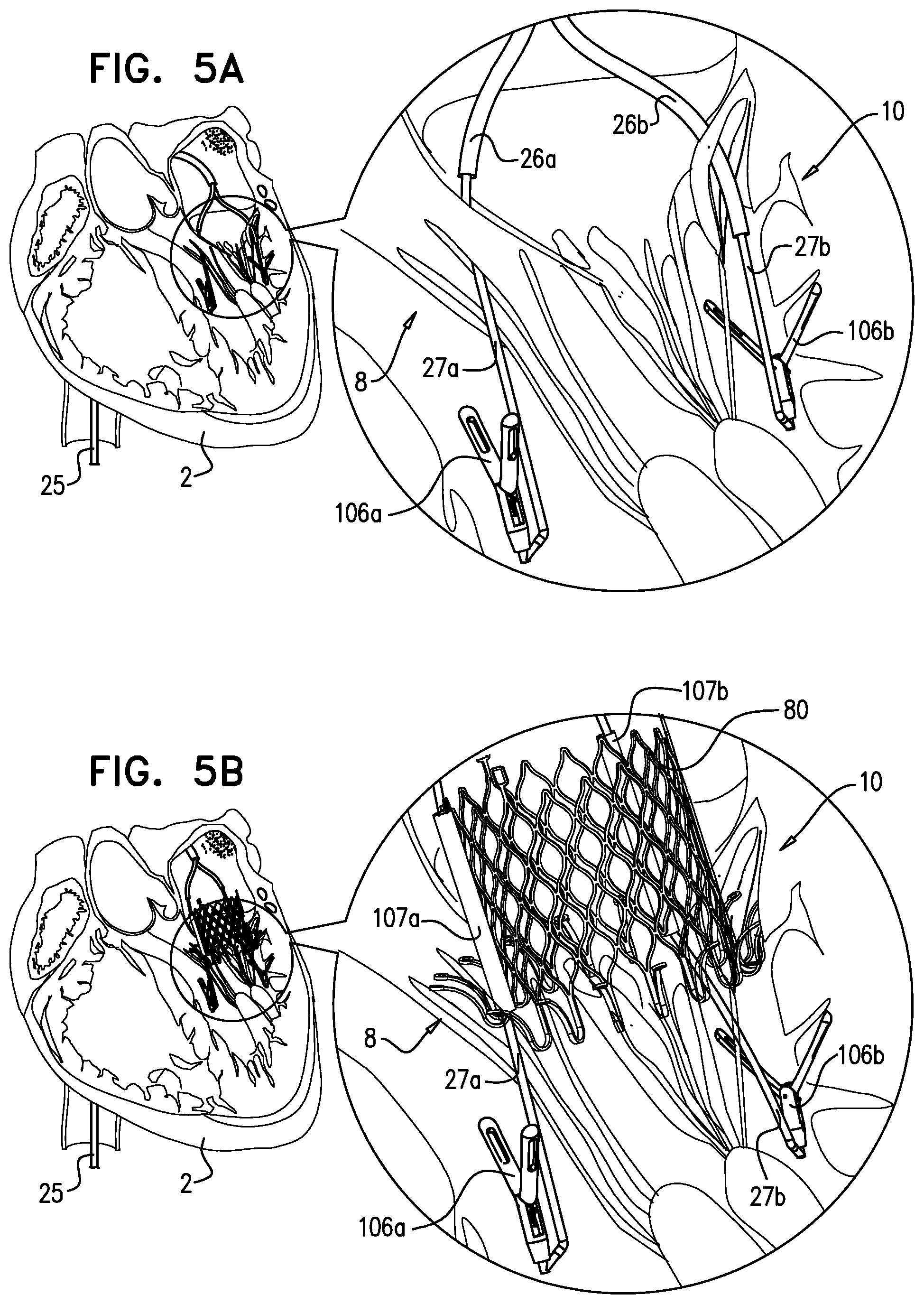 Patent US12310575 Figure 13 – Helical anchor implantation