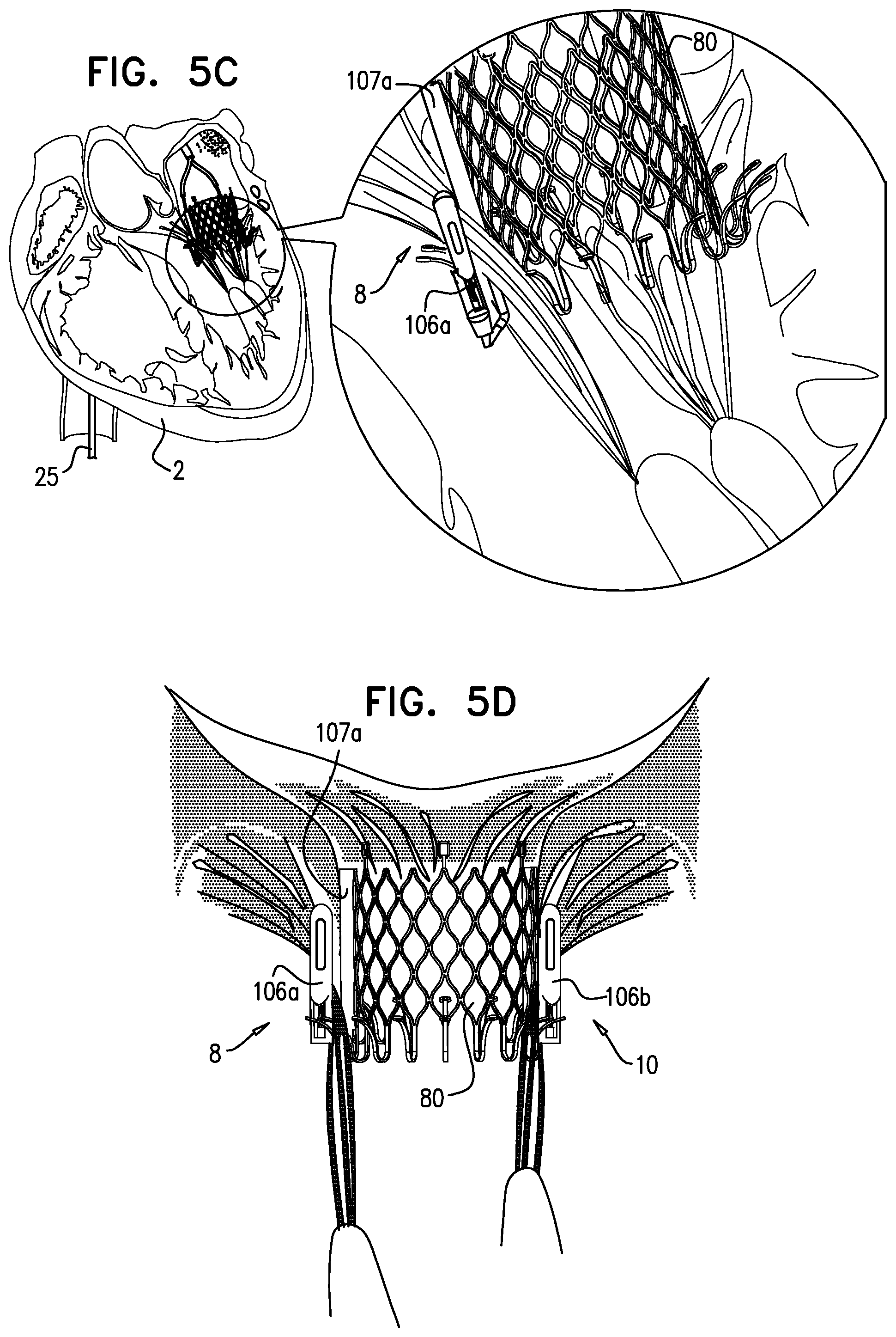Patent US12310575 Figure 14 – Helical anchor implantation