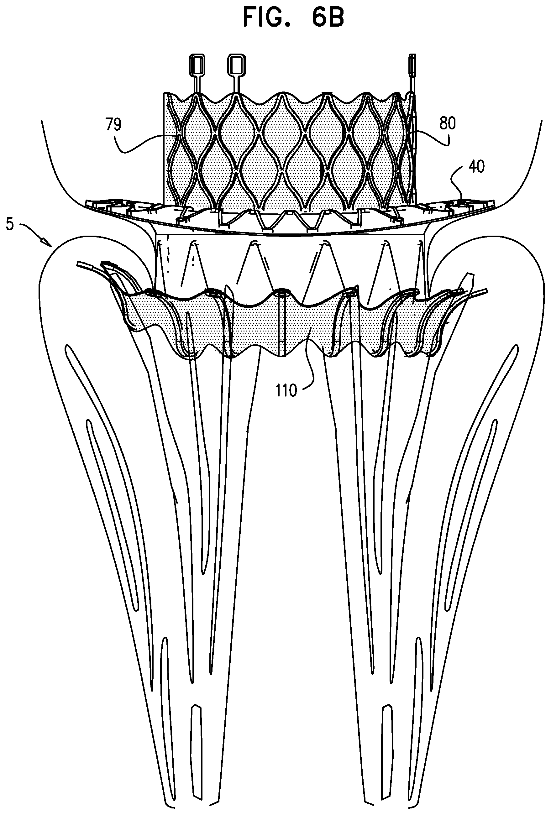 Patent US12310575 Figure 16 – Helical anchor implantation