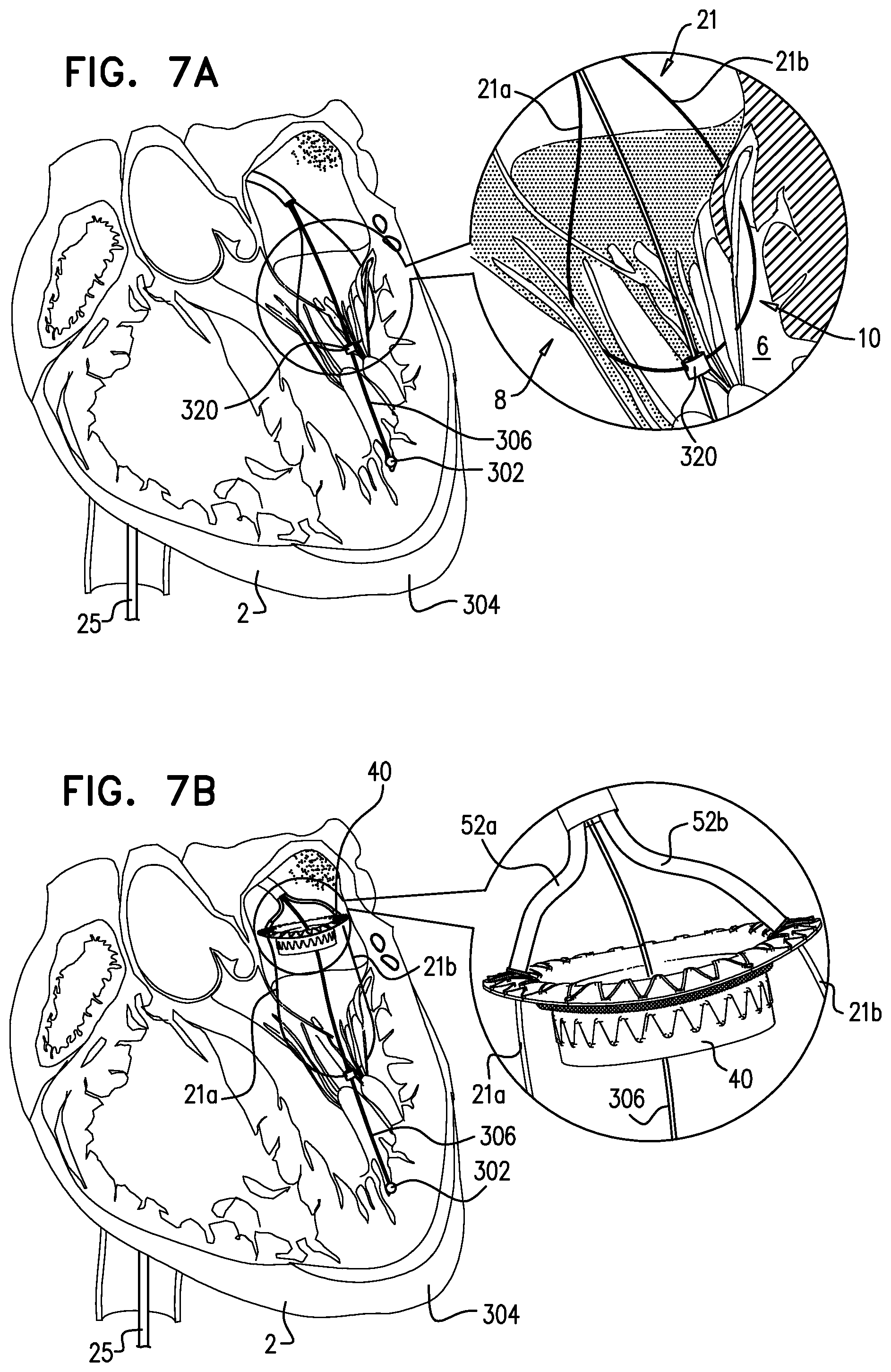 Patent US12310575 Figure 17 – Helical anchor implantation