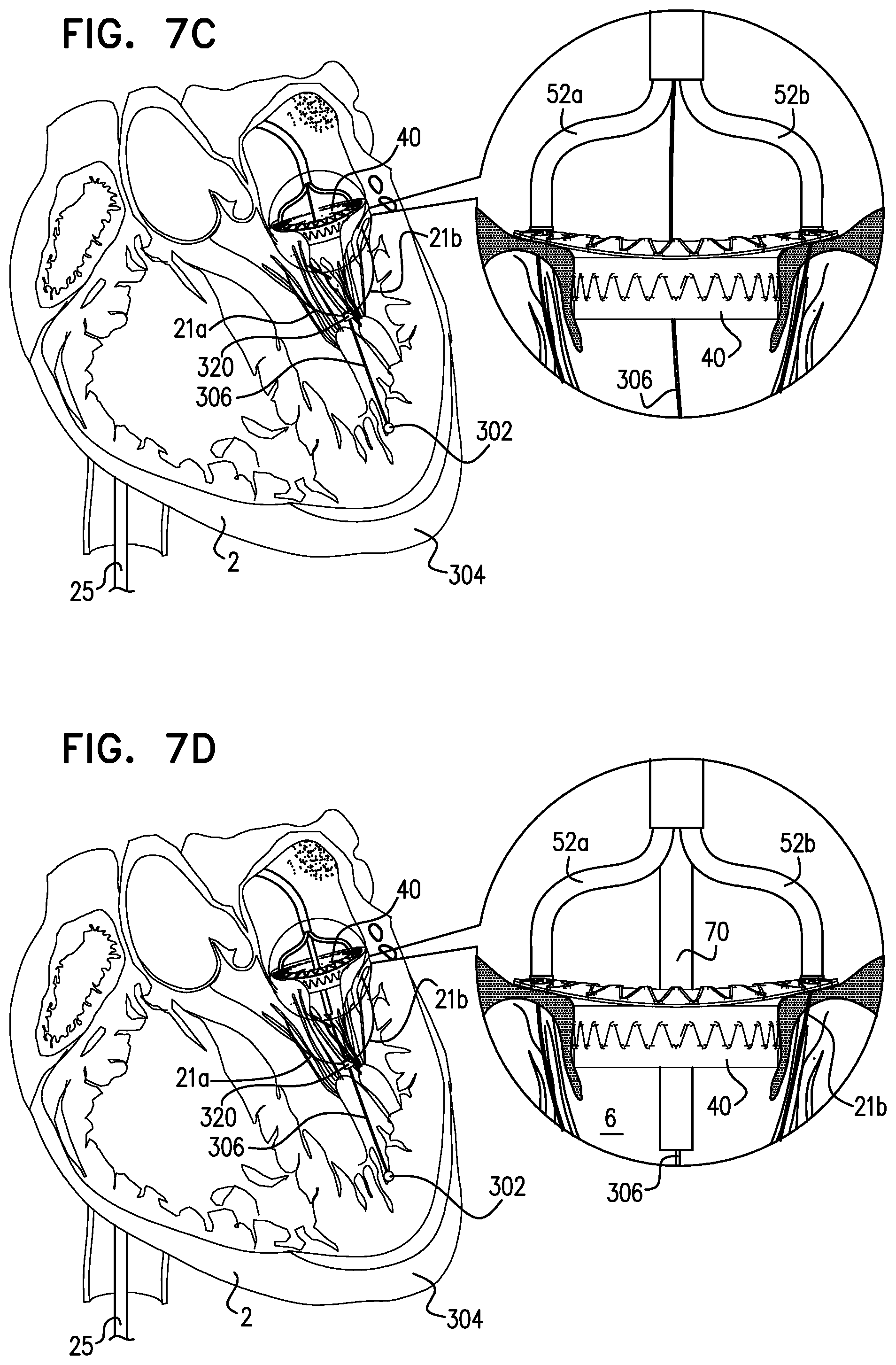 Patent US12310575 Figure 18 – Helical anchor implantation