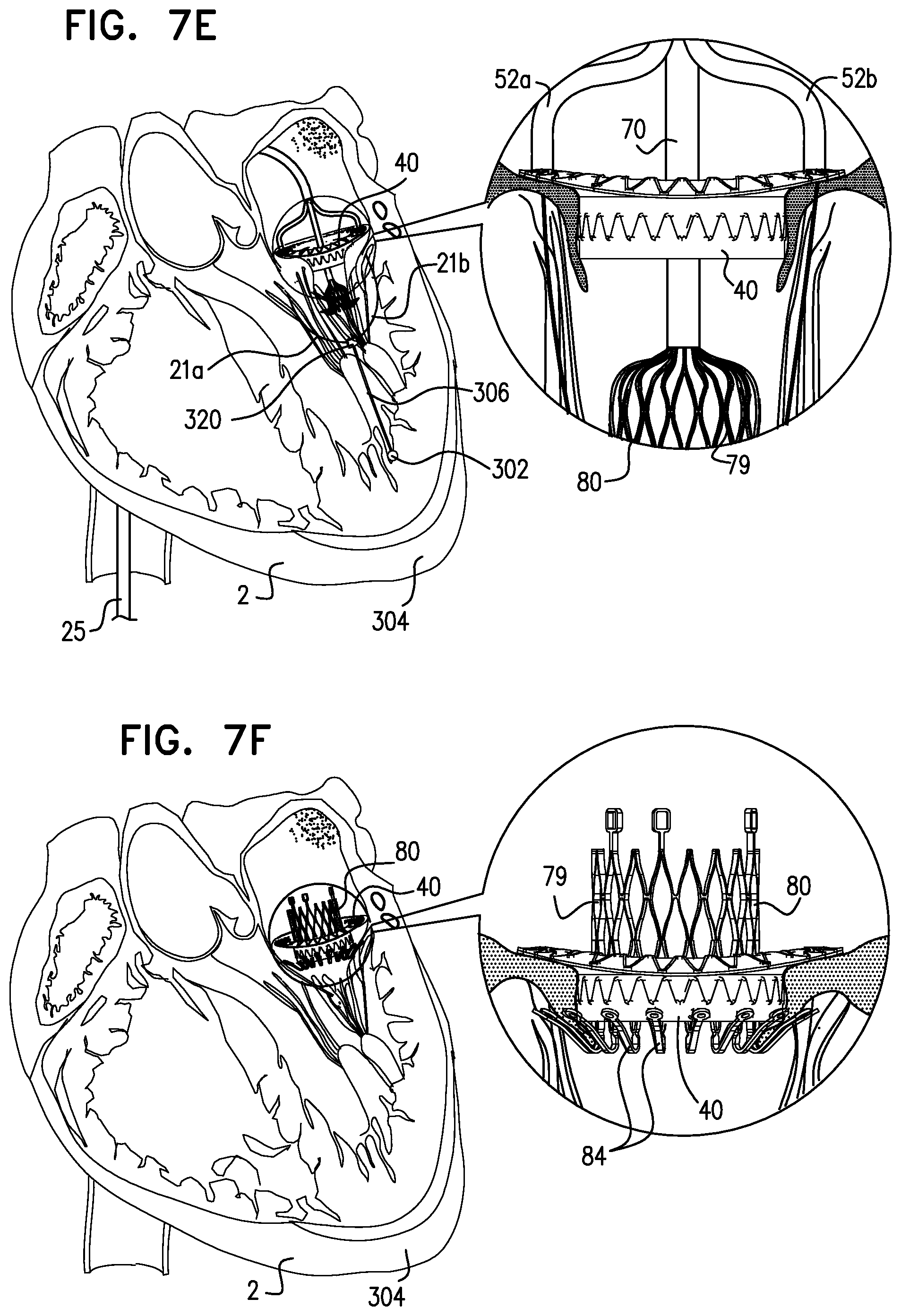 Patent US12310575 Figure 19 – Helical anchor implantation
