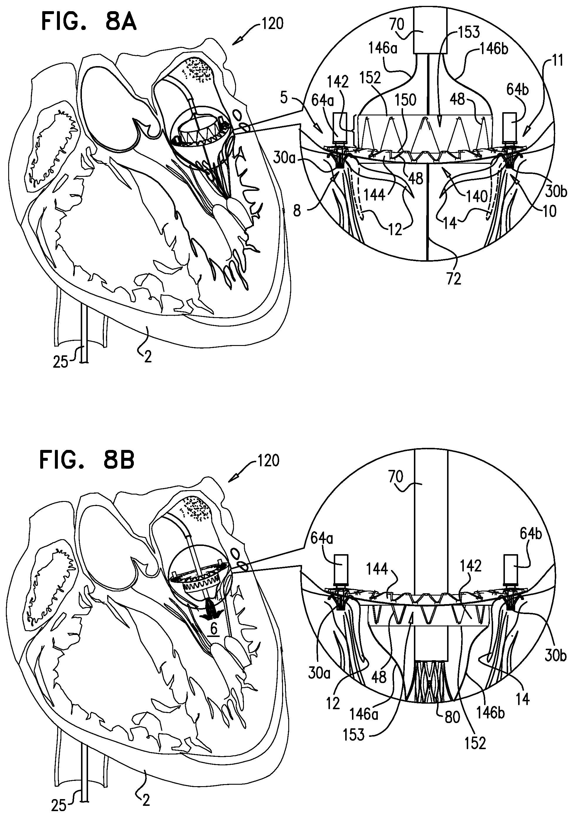 Patent US12310575 Figure 20 – Helical anchor implantation