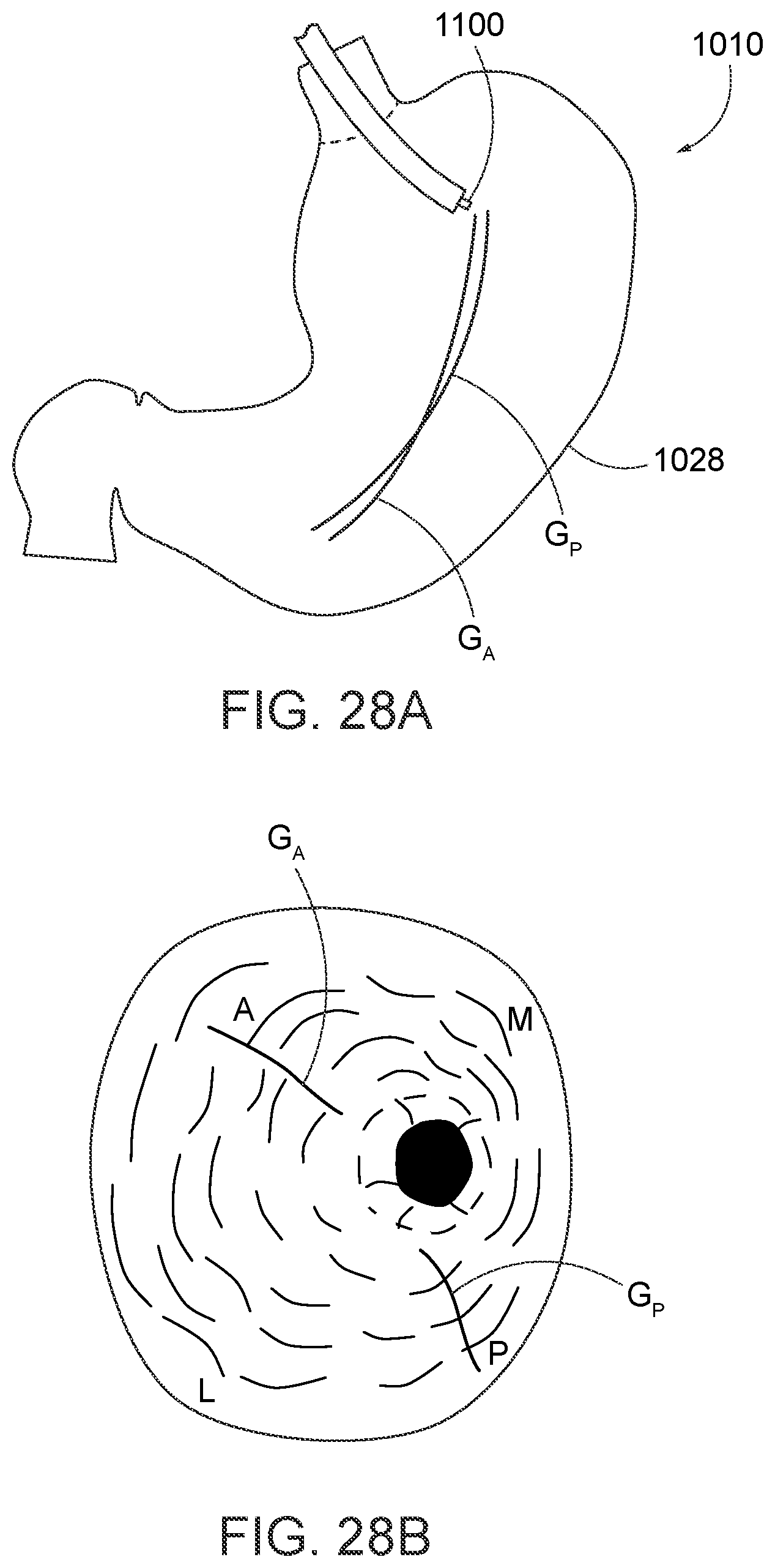 Patent US12310578 Figure 15 – Endoscopic suture loop anchors and methods