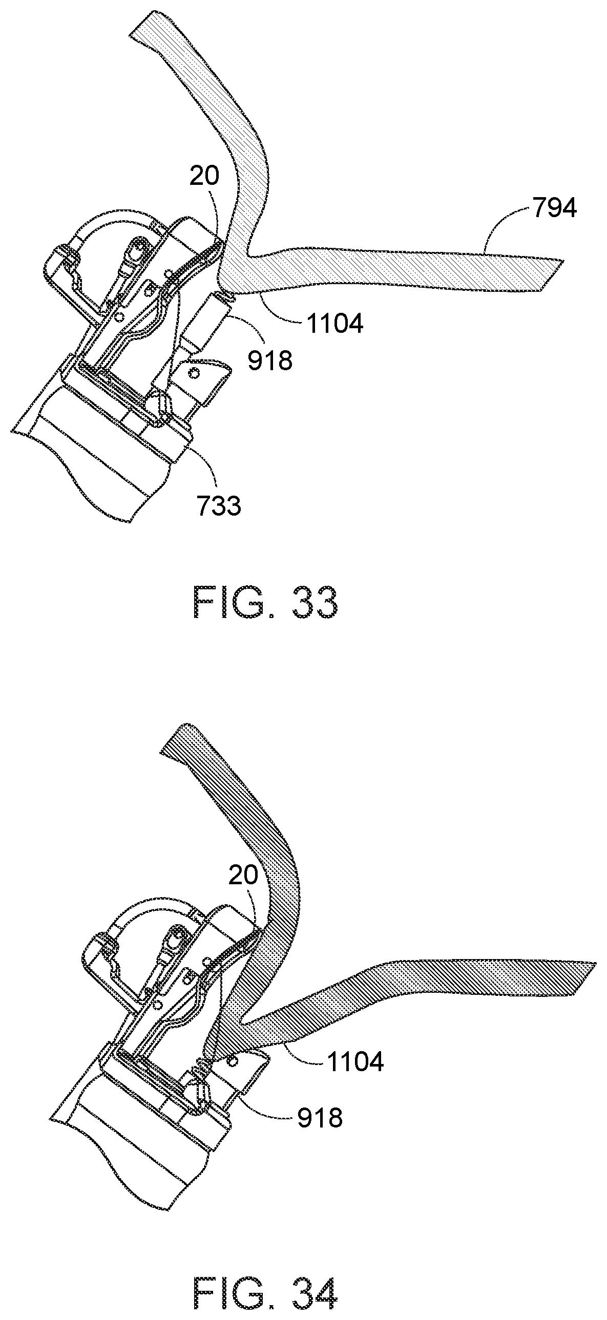 Patent US12310578 Figure 18 – Endoscopic suture loop anchors and methods
