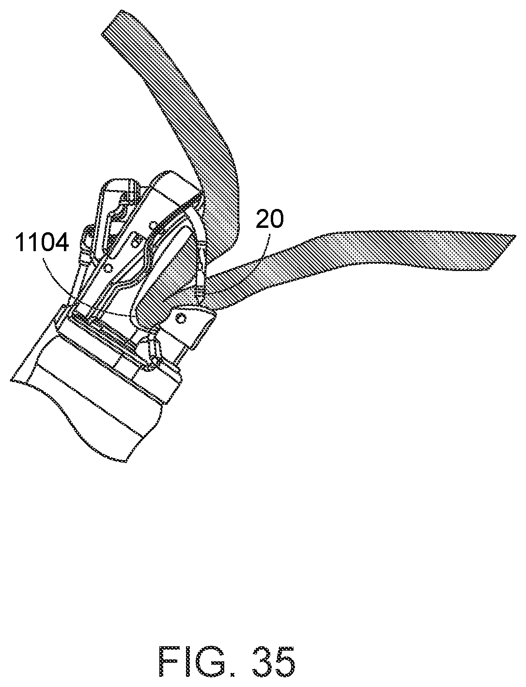 Patent US12310578 Figure 19 – Endoscopic suture loop anchors and methods